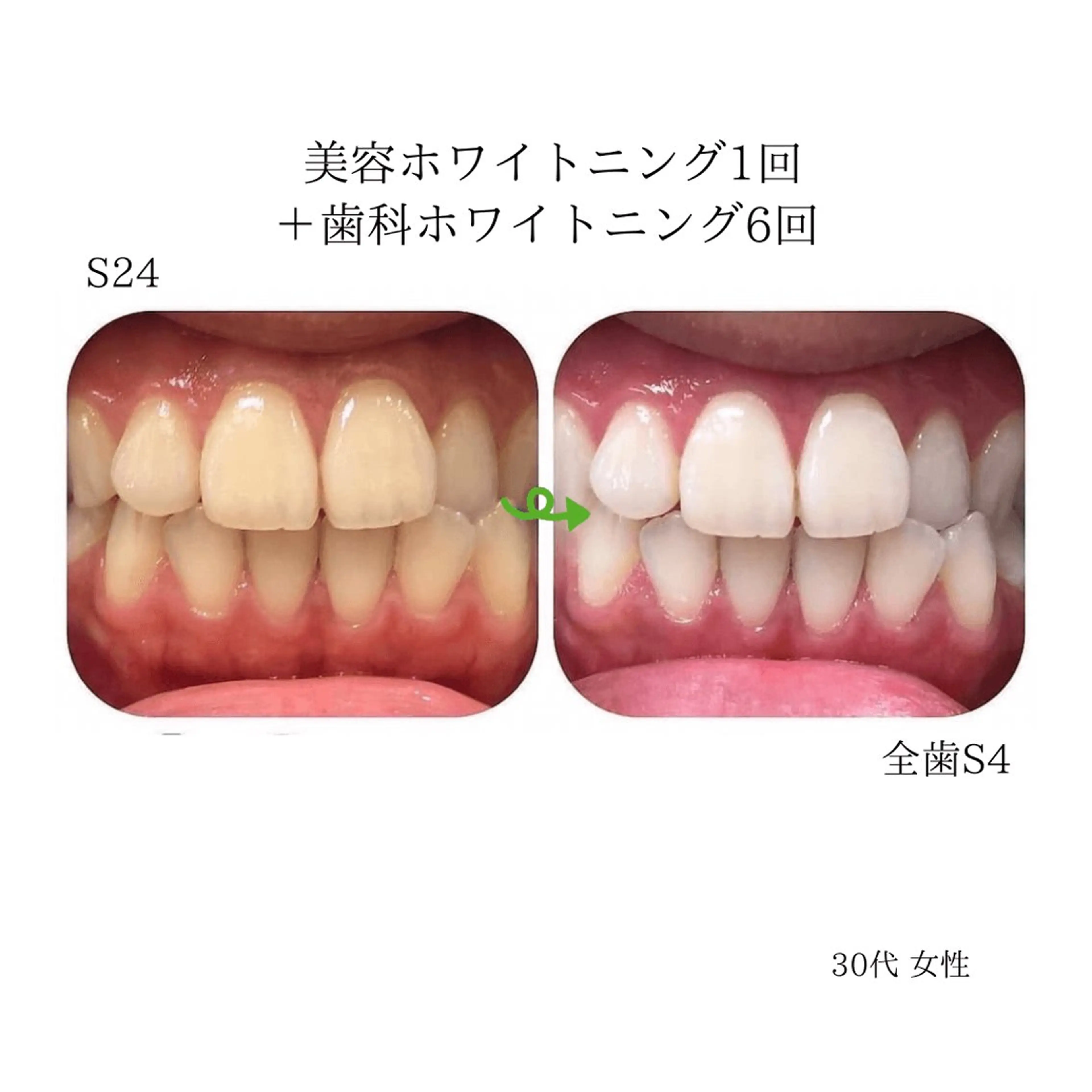 歯のセルフホワイトニング専門店GLOW（グロウ）所属・東区香椎歯のセルフホ ワイトニングGLOWのその他イメージ