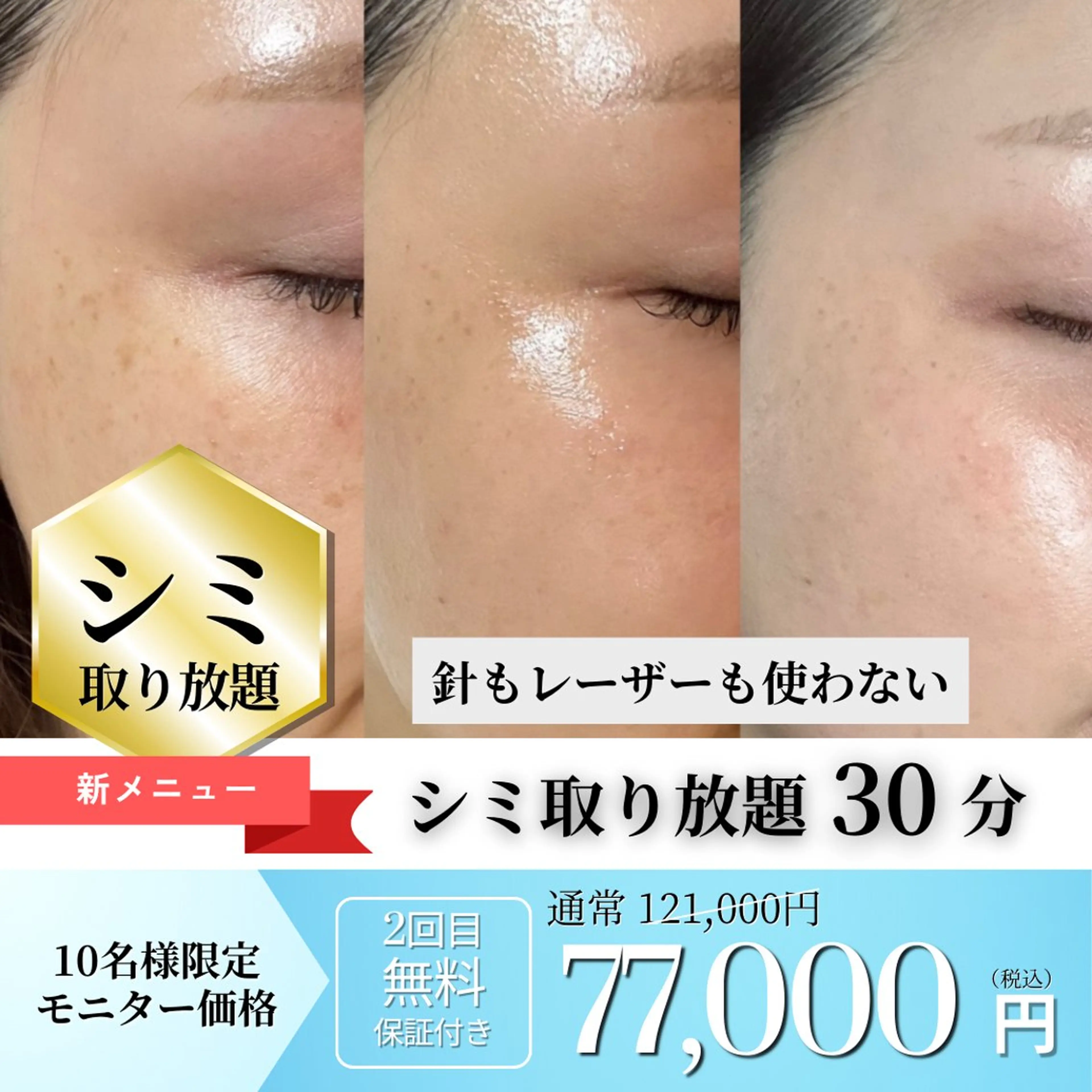 💎シミ取り放題30分／2回目施術無料保証付きの写真