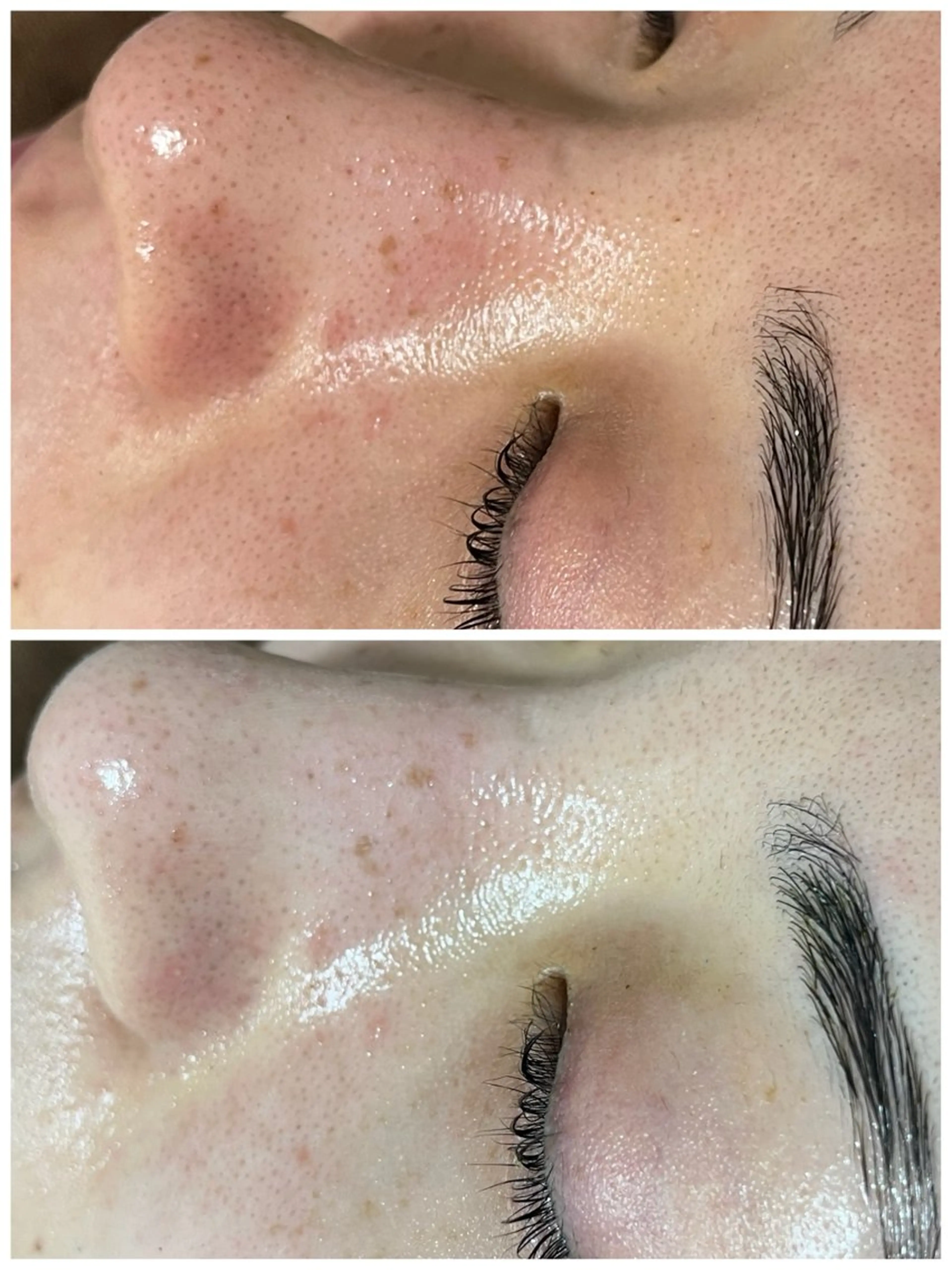 ニキビ／毛穴ケア ハーブピーリングのエステ・リラクイメージ