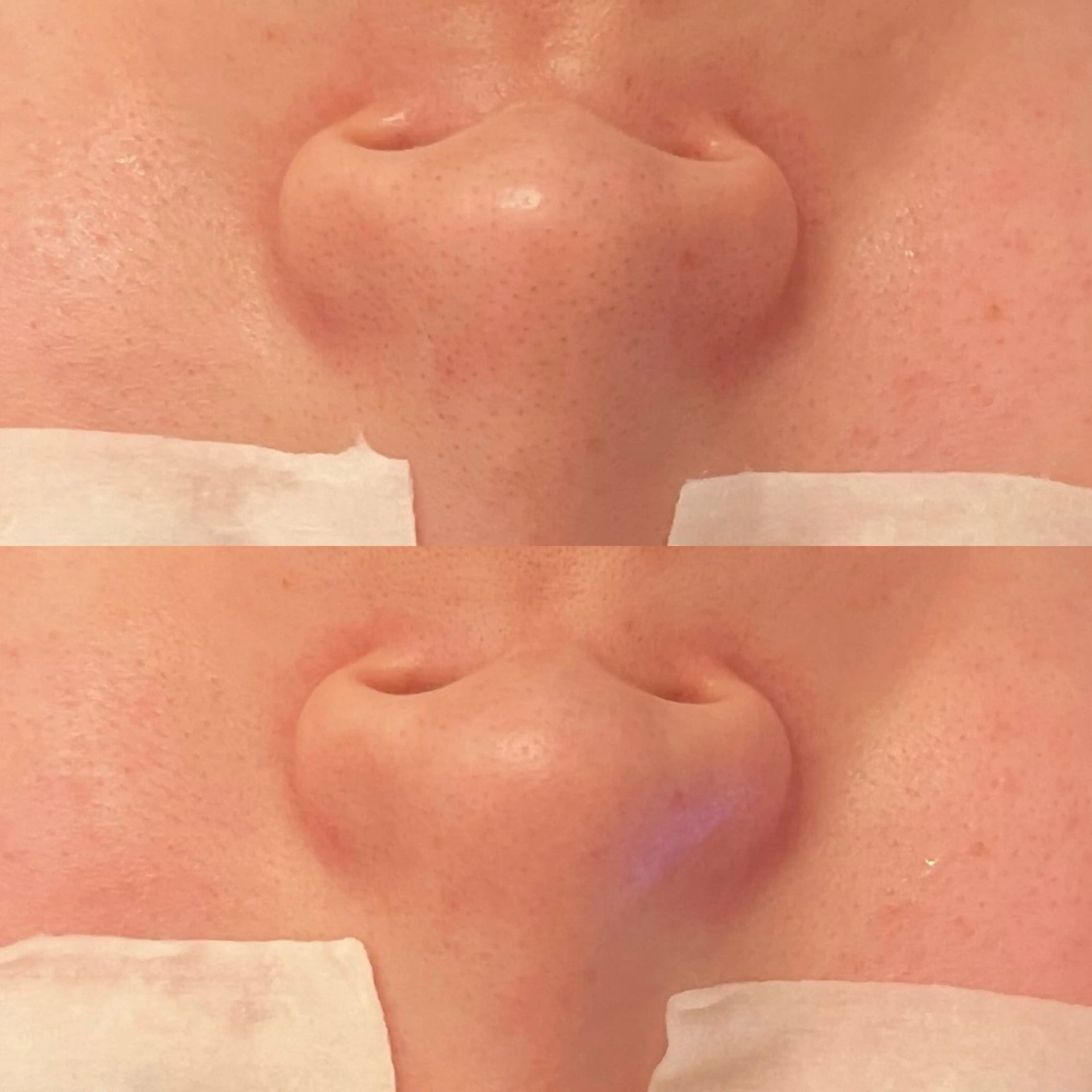 エステ 毛穴ケア/毛穴診断/ 毛穴洗浄〔心斎橋〕のエステ・リラクイメージ