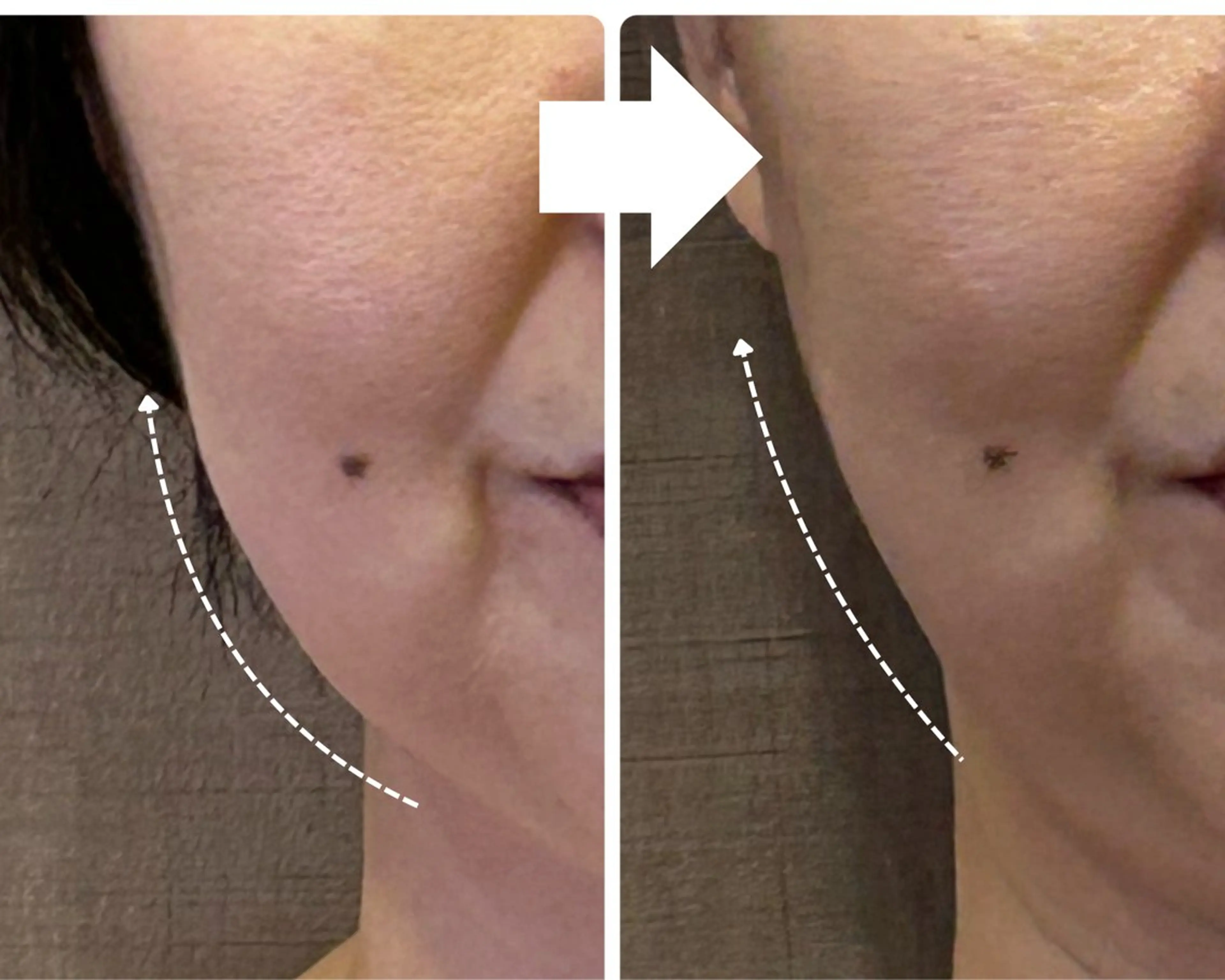 整形なしで！ツヤ肌小顔リフトアップフェイシャルの写真