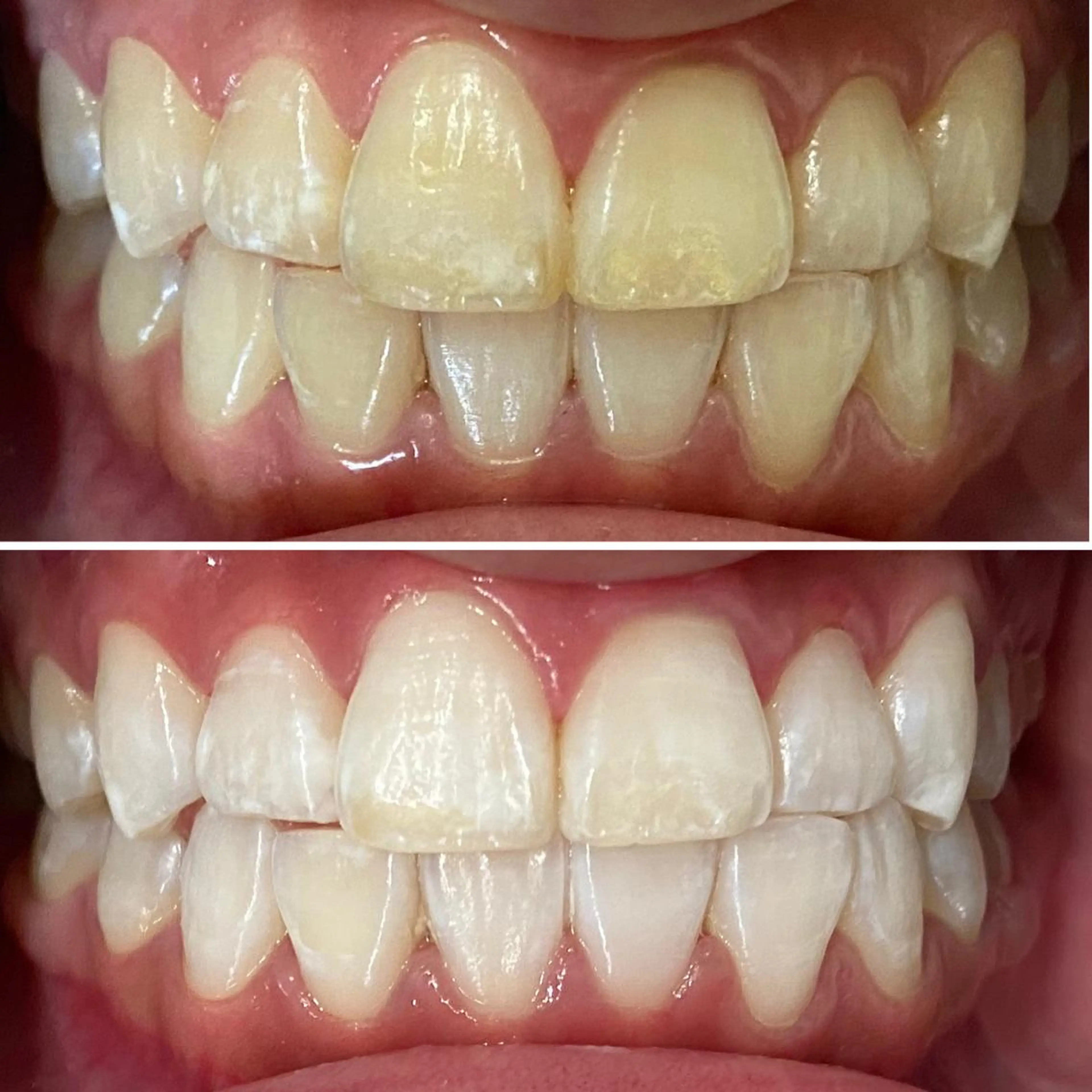 ショート カラー メンズ ネイル その他 ホワイトニング ⚓︎CREW柏⚓︎のその他イメージ