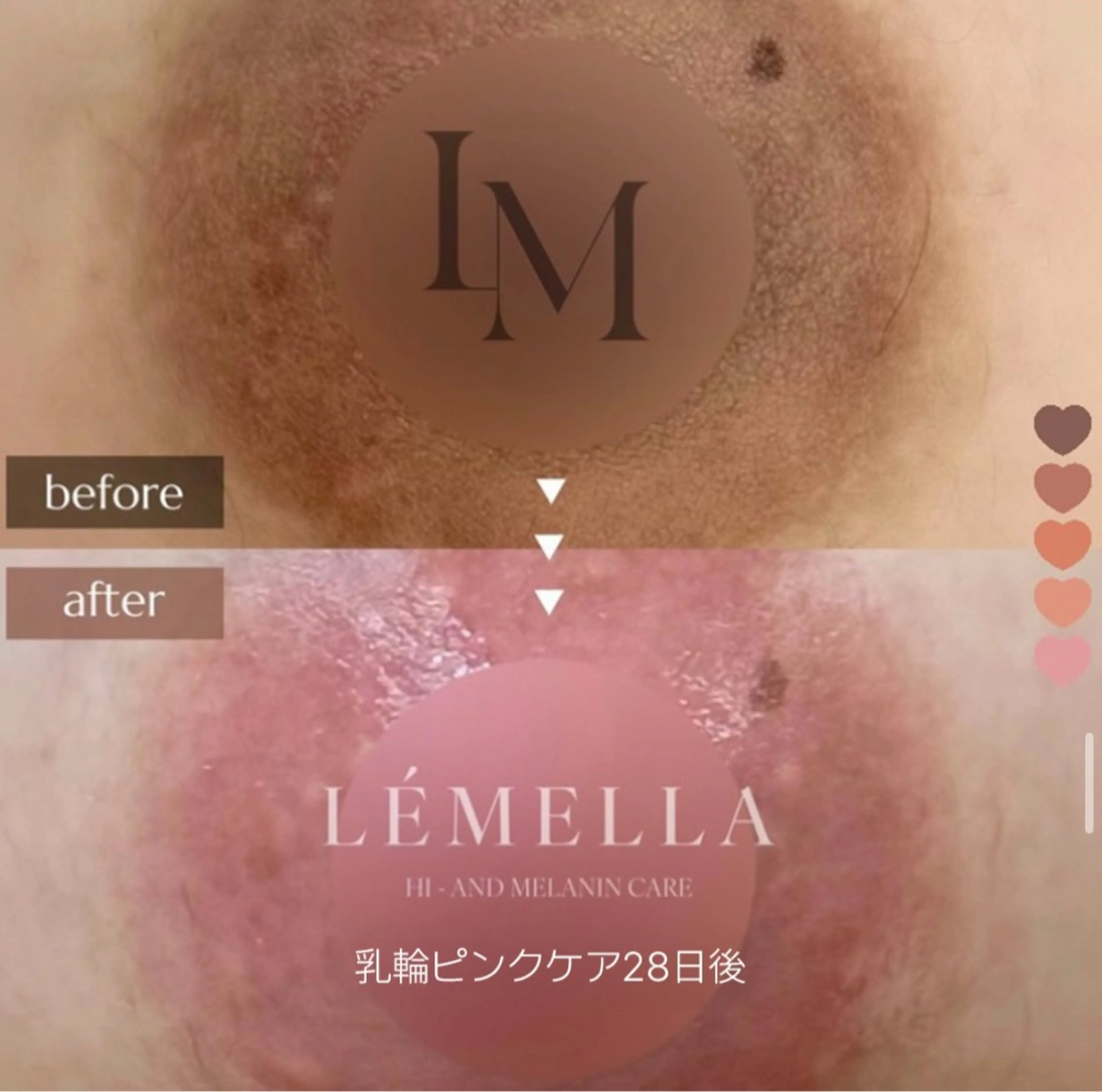 ルメラ🧸12月限定(乳輪）半永久！¥60,000→モニターさん募集の写真