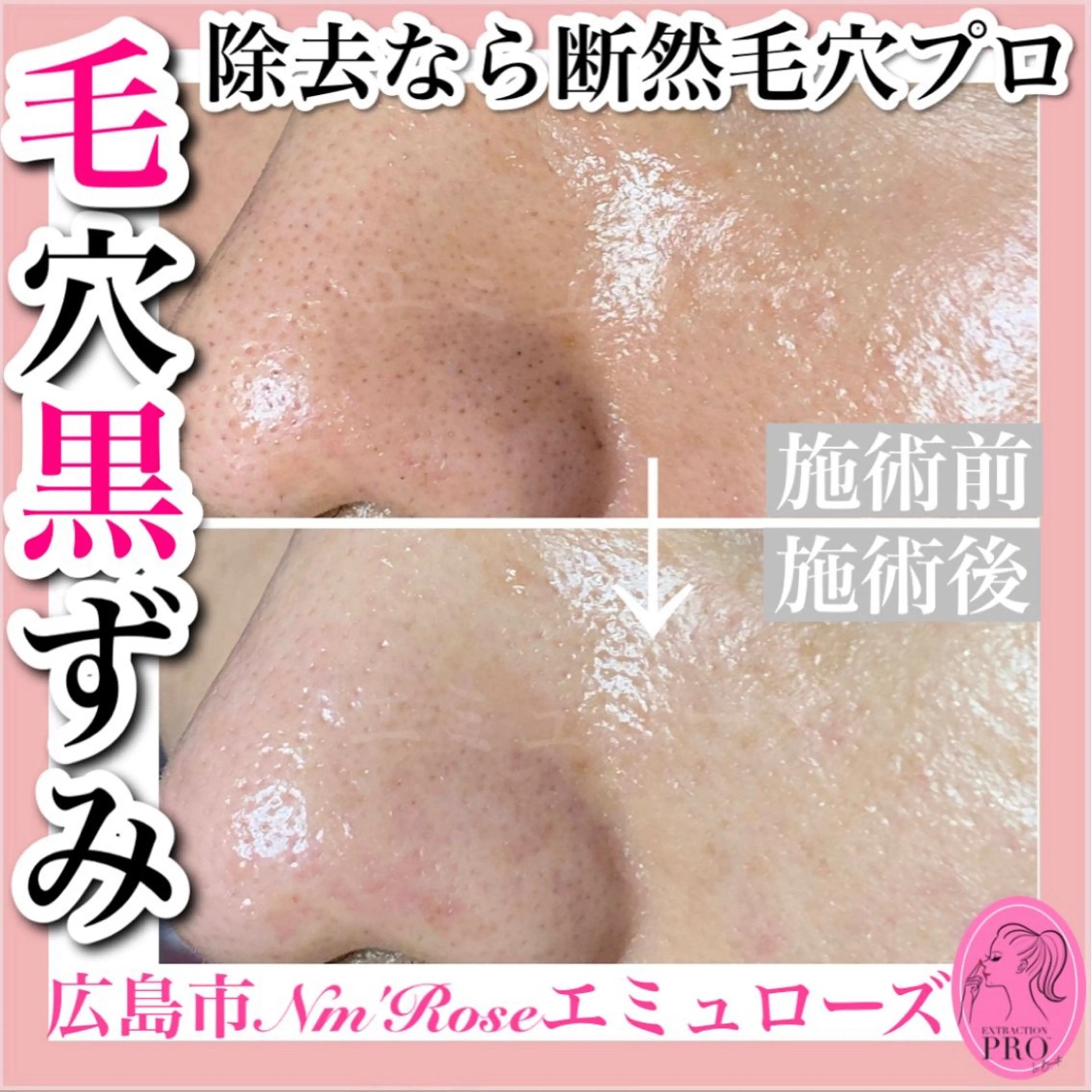 毛穴フェイシャルの写真