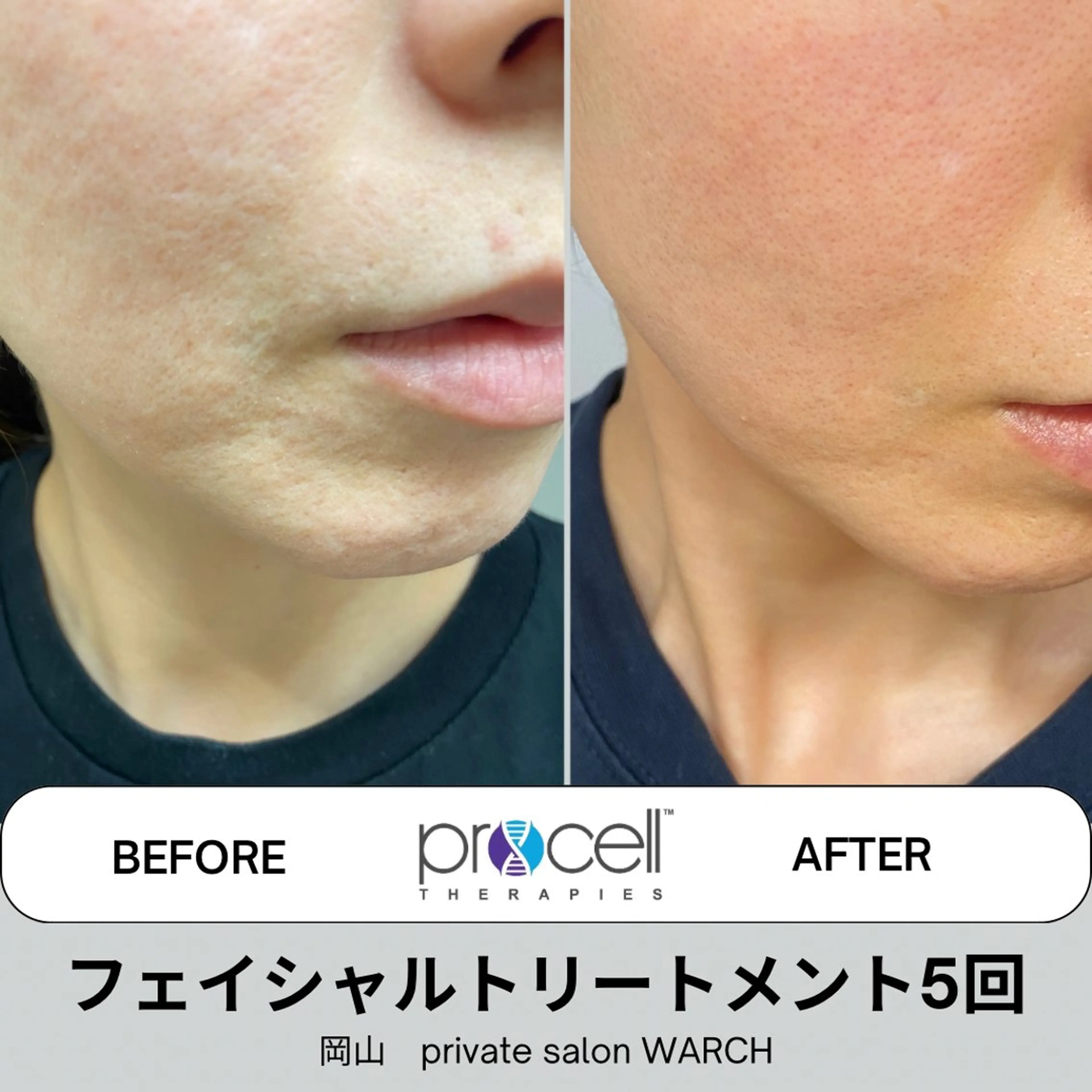 【本気の肌質改善】プロセルフェイシャル（凸凹肌）￥50,000→￥40,000の写真