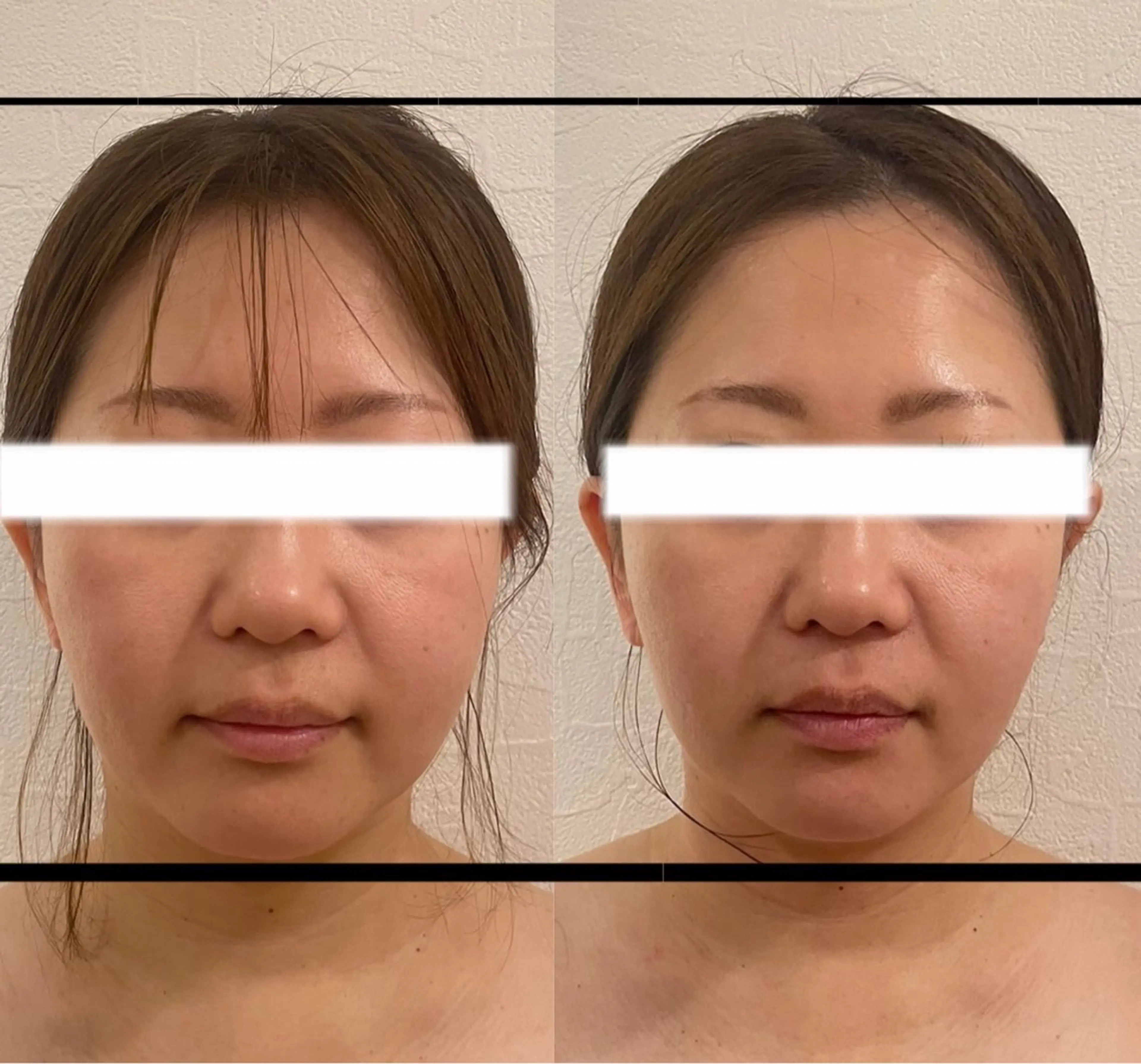 💖限定💖小顔コルギ、カッサ、ストーンセラピー💆‍♀️オリジナルコルギで理想に近づける！の写真