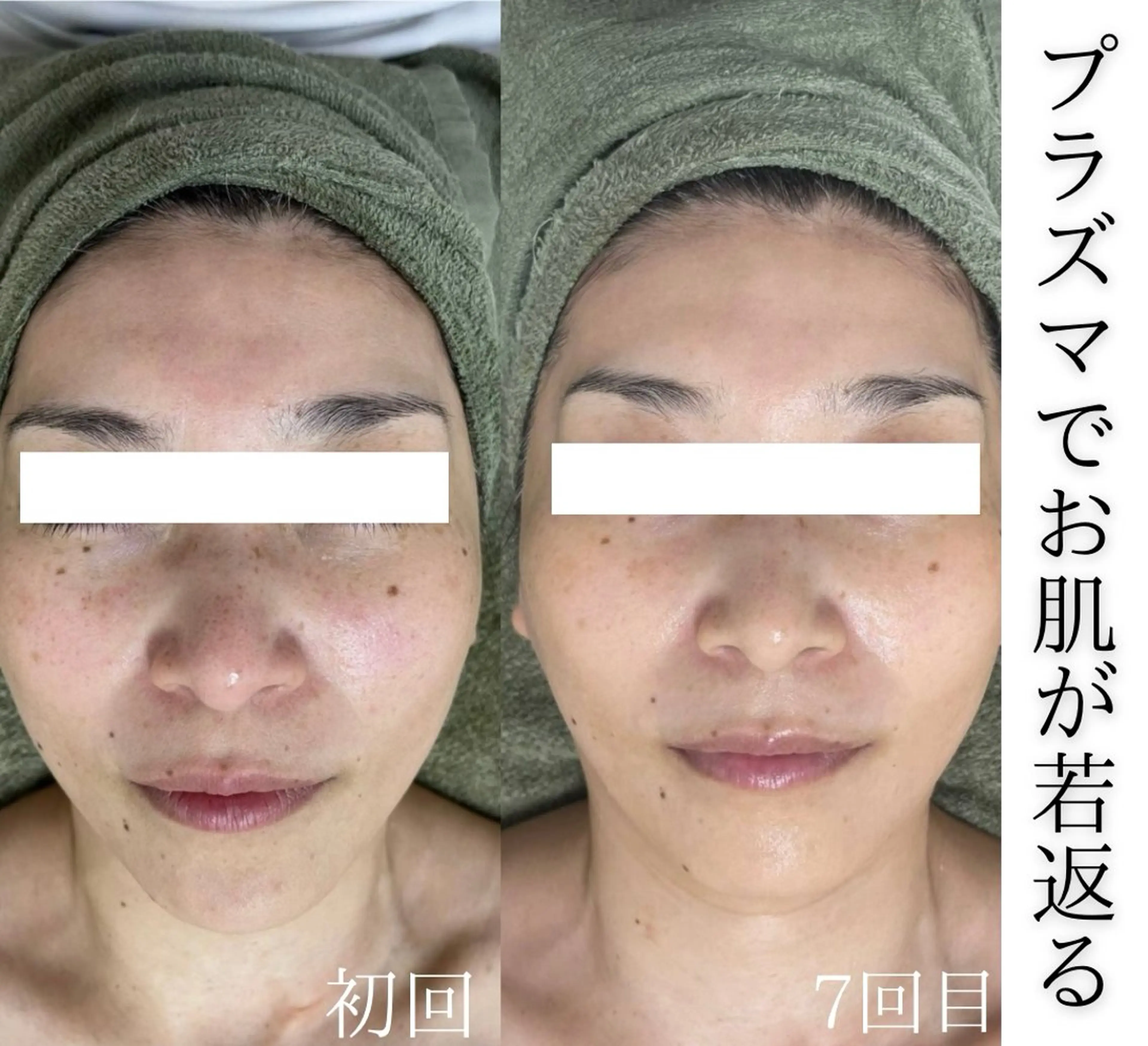 【根本的肌質改善】プラズマフェイシャル！の写真