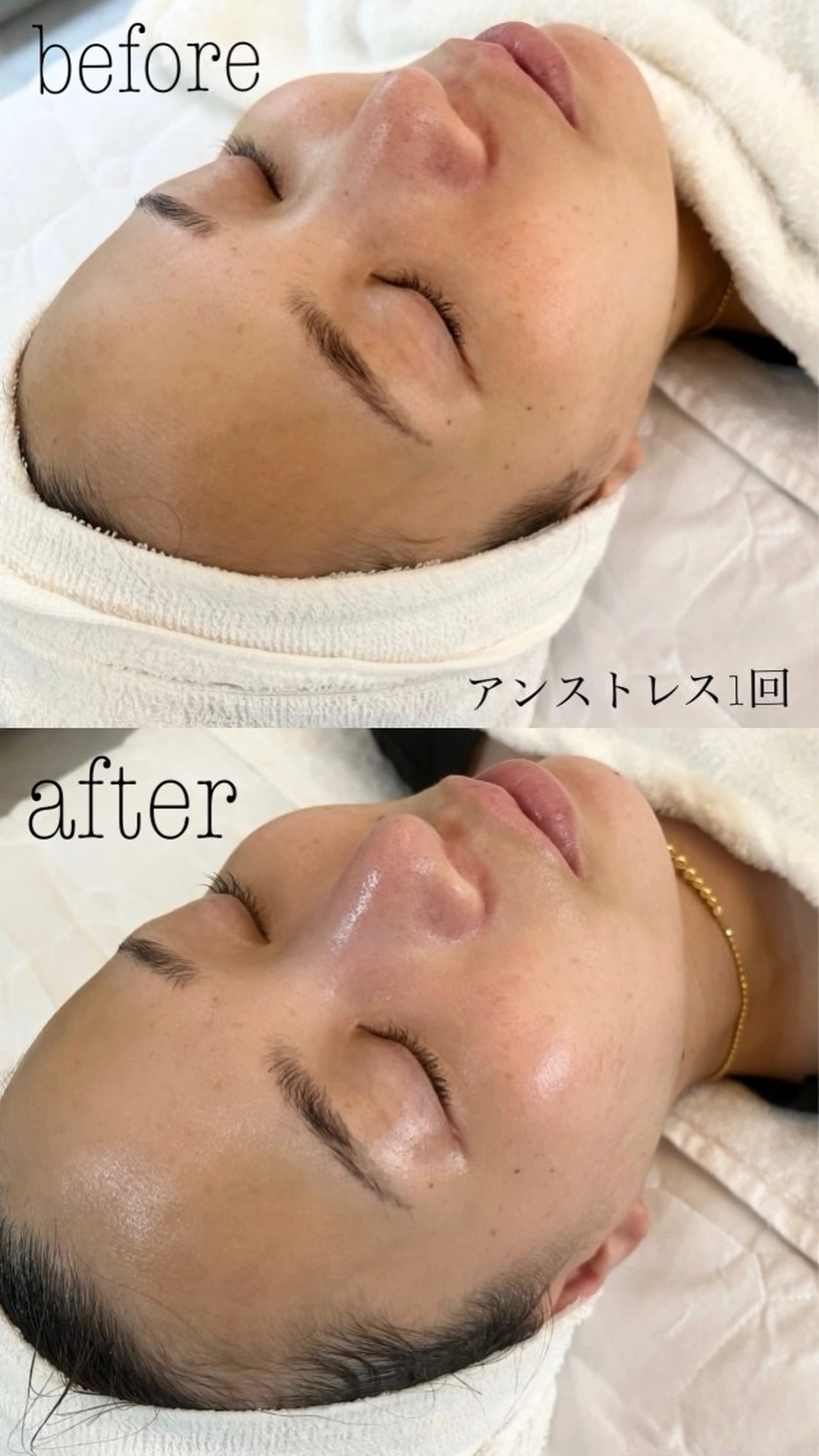 エステ 肌質改善|美眉サロンCannone'所属・肌質改善|美眉サロン Cannone’のエステ・リラクイメージ