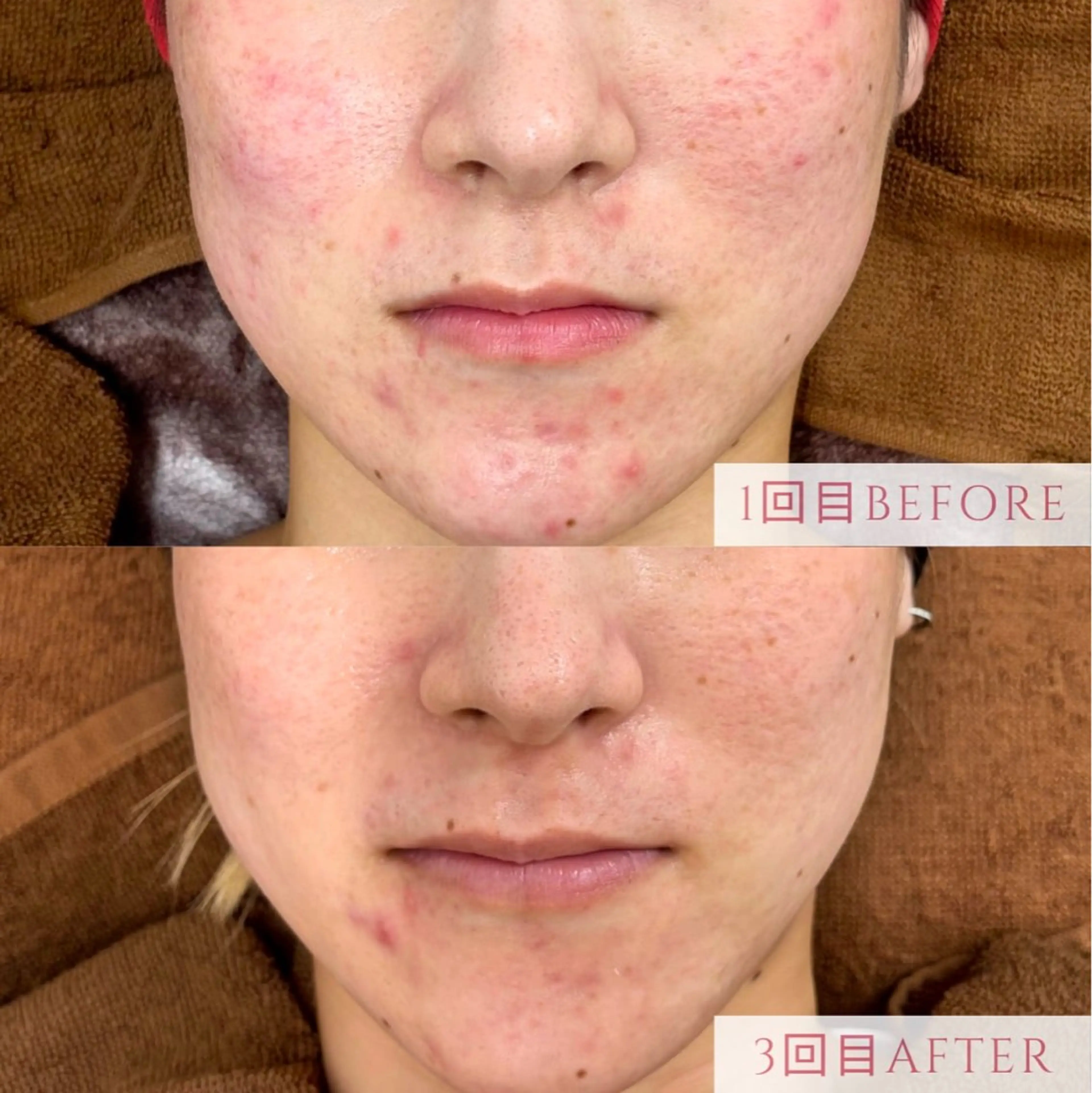 エステ 肌質改善/小顔/ ナスサロ/Yuiのエステ・リラクイメージ