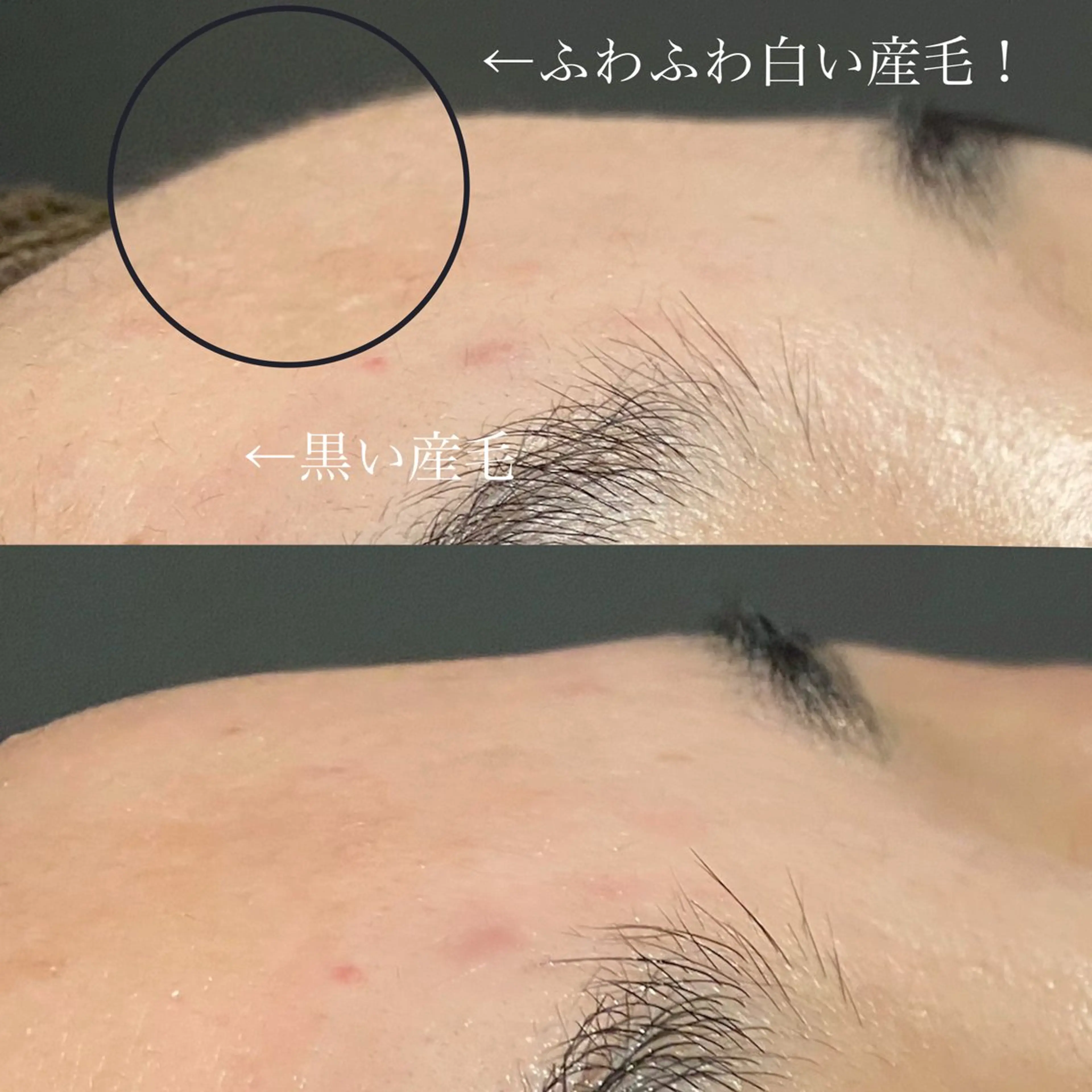 肌質改善🌿ニキビ・毛穴ケアにも◎「潤いシェービング🫧✨」の写真