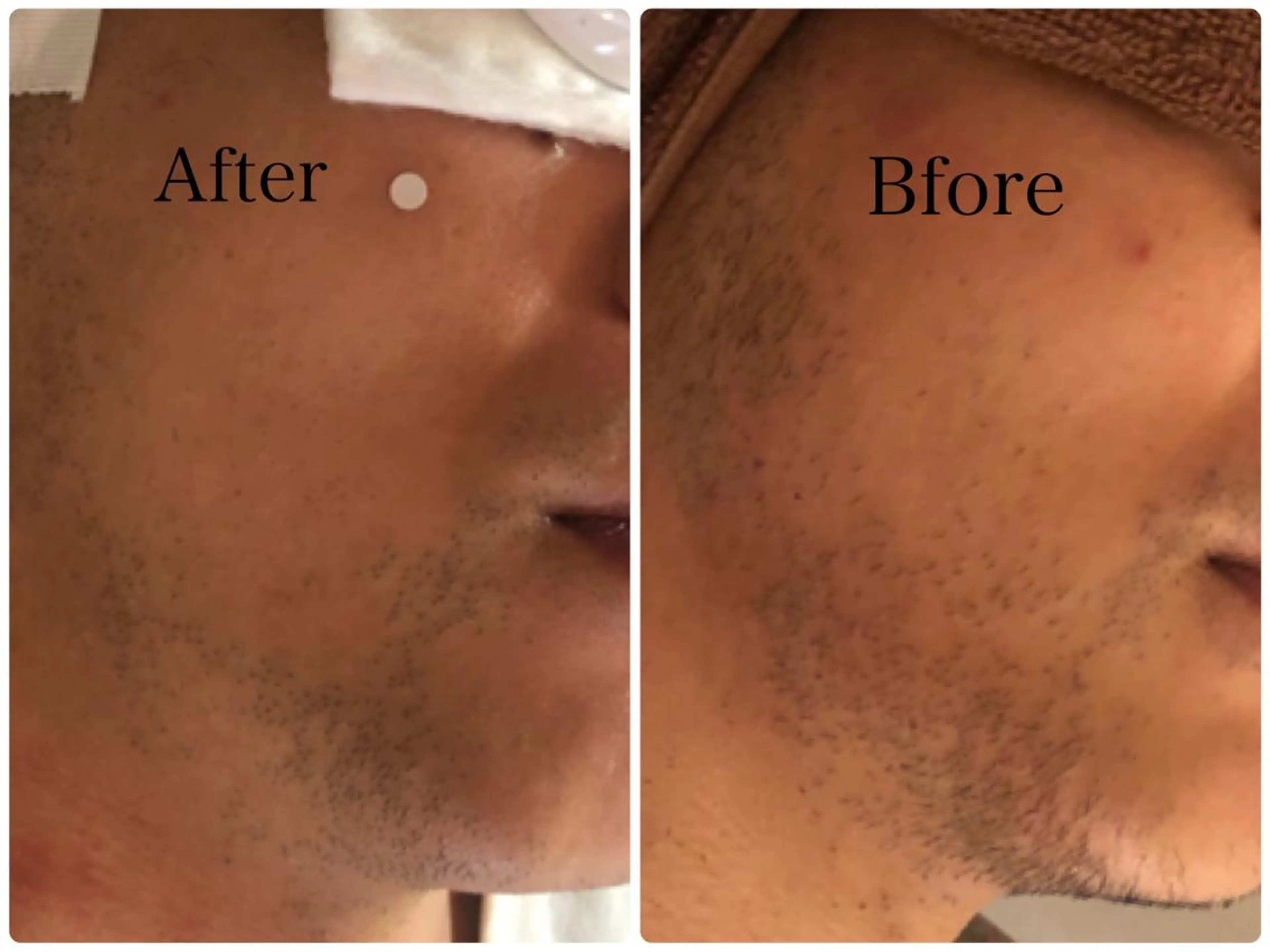 【効果あり】メンズ👨ひげ脱毛の写真