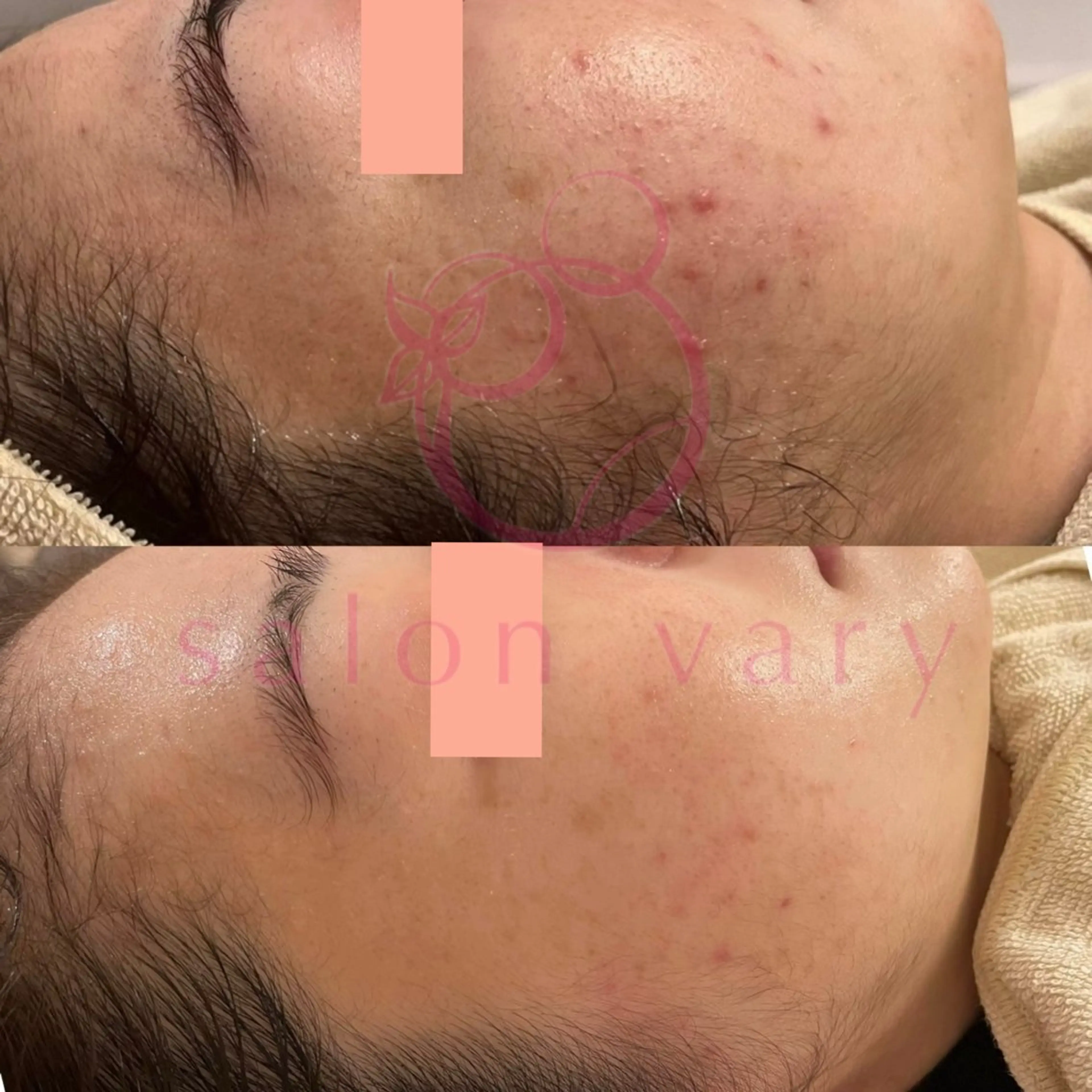 【ニキビ/肌管理】 salon varyのエステ・リラクイメージ