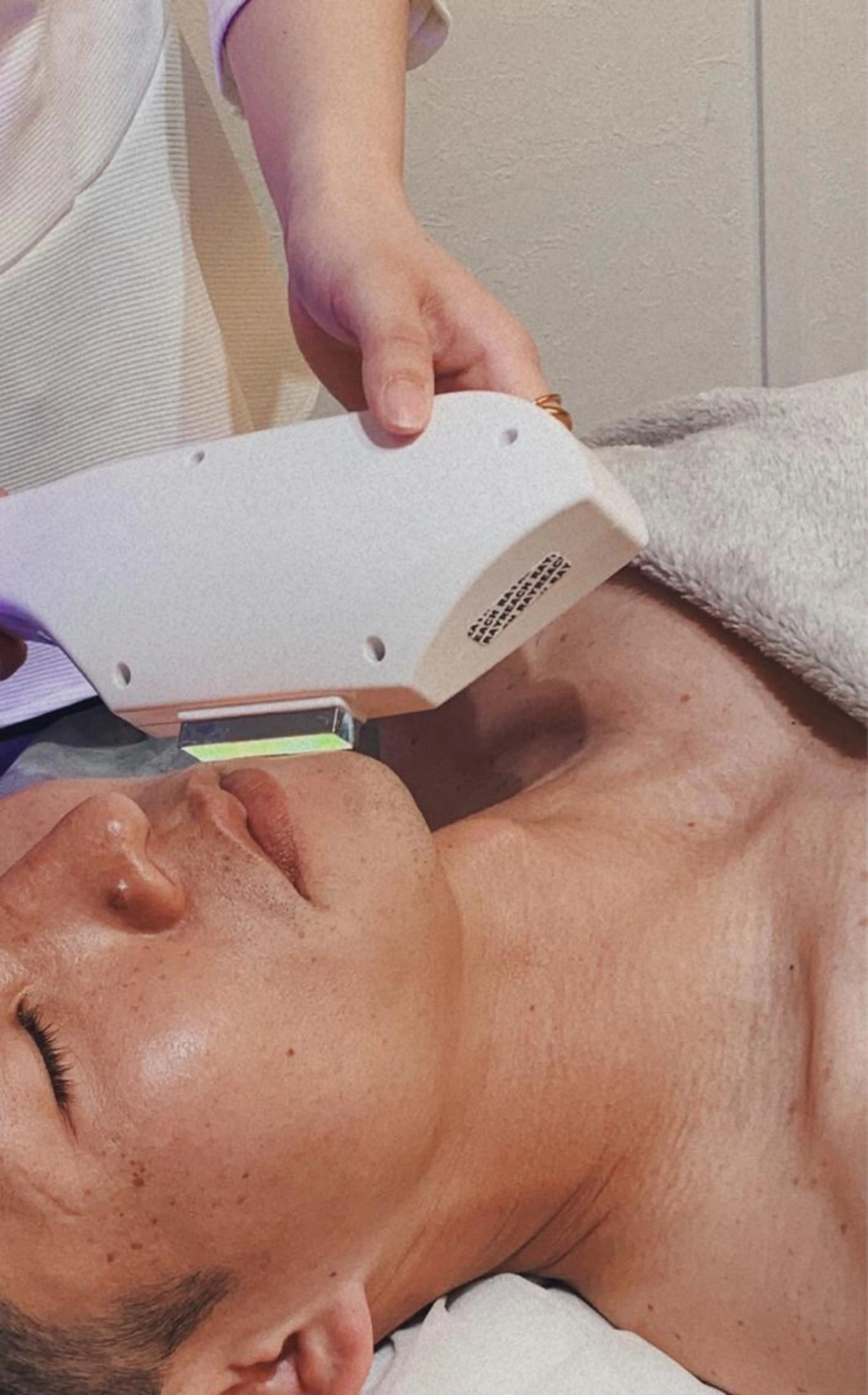 初回限定【メンズ全顔（眉毛＆ヒゲ）脱毛】清潔感up！美肌効果の写真