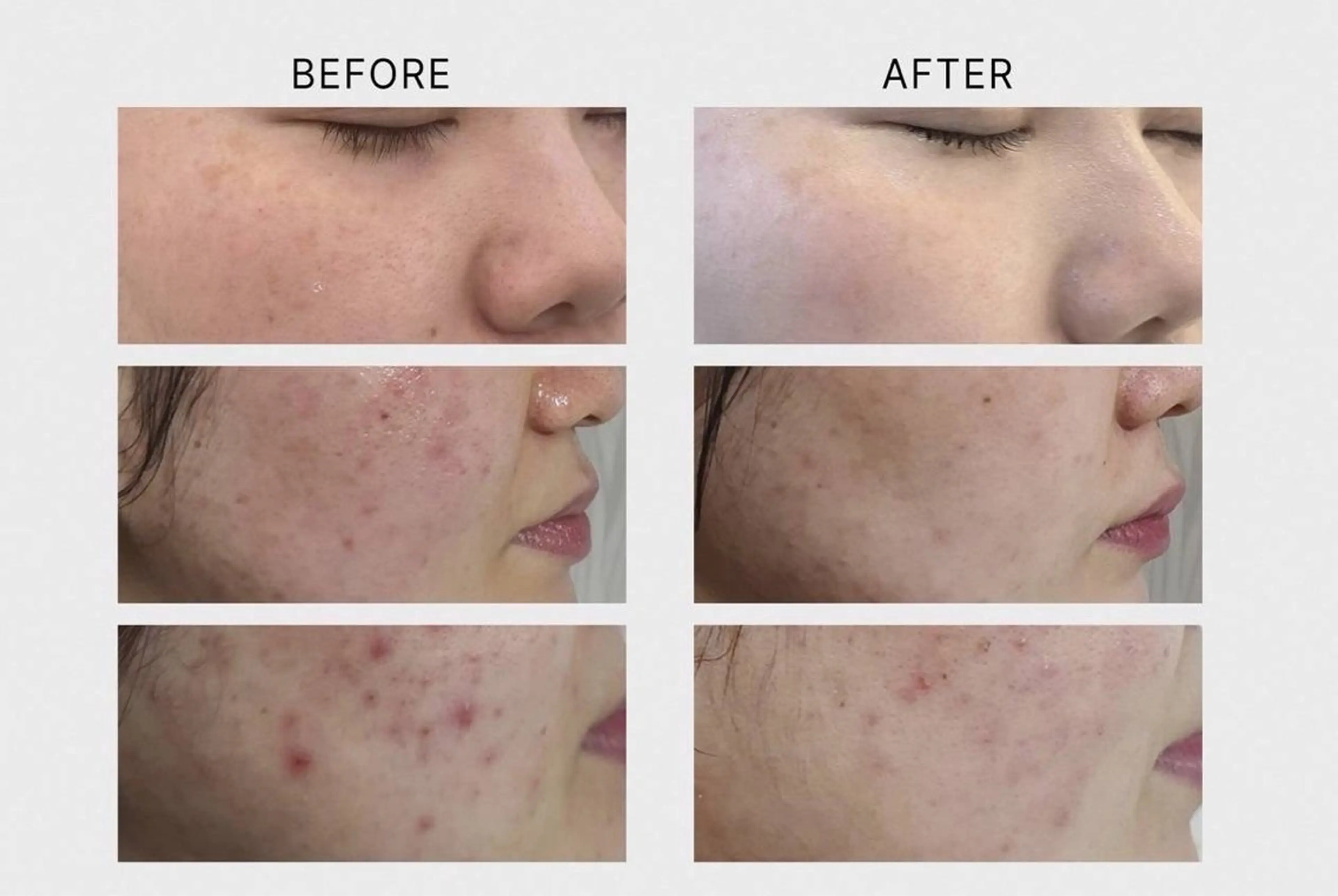 韓国式ハープピーリングの写真