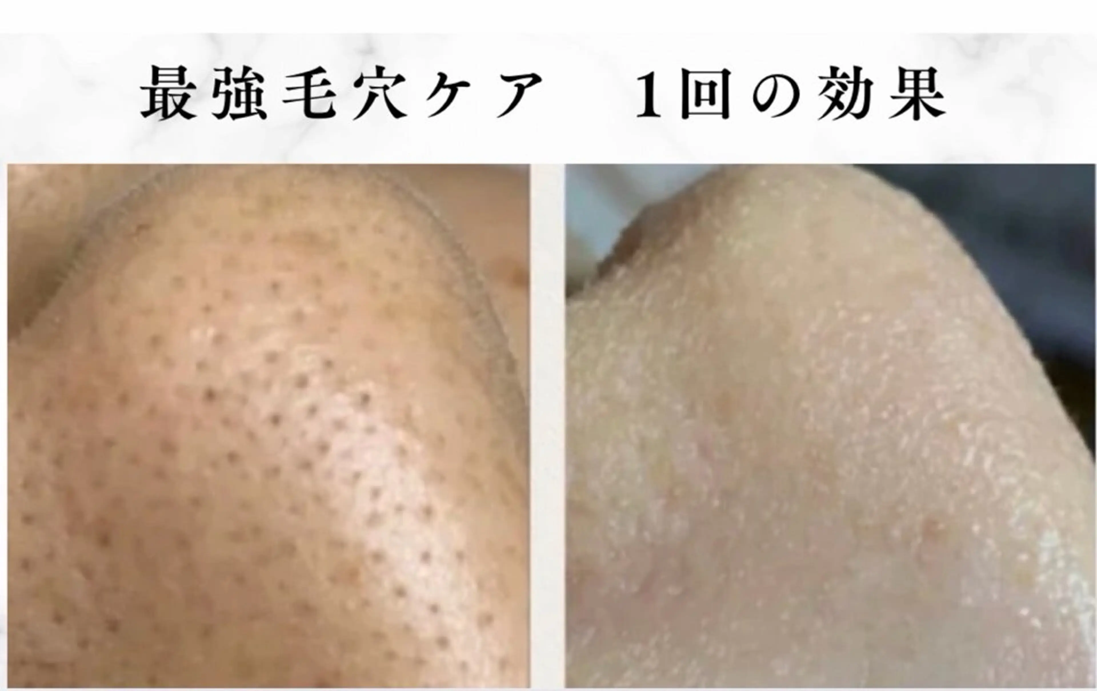 医療提携/ニキビ毛穴 サロンドエクラ南堀江のエステ・リラクイメージ