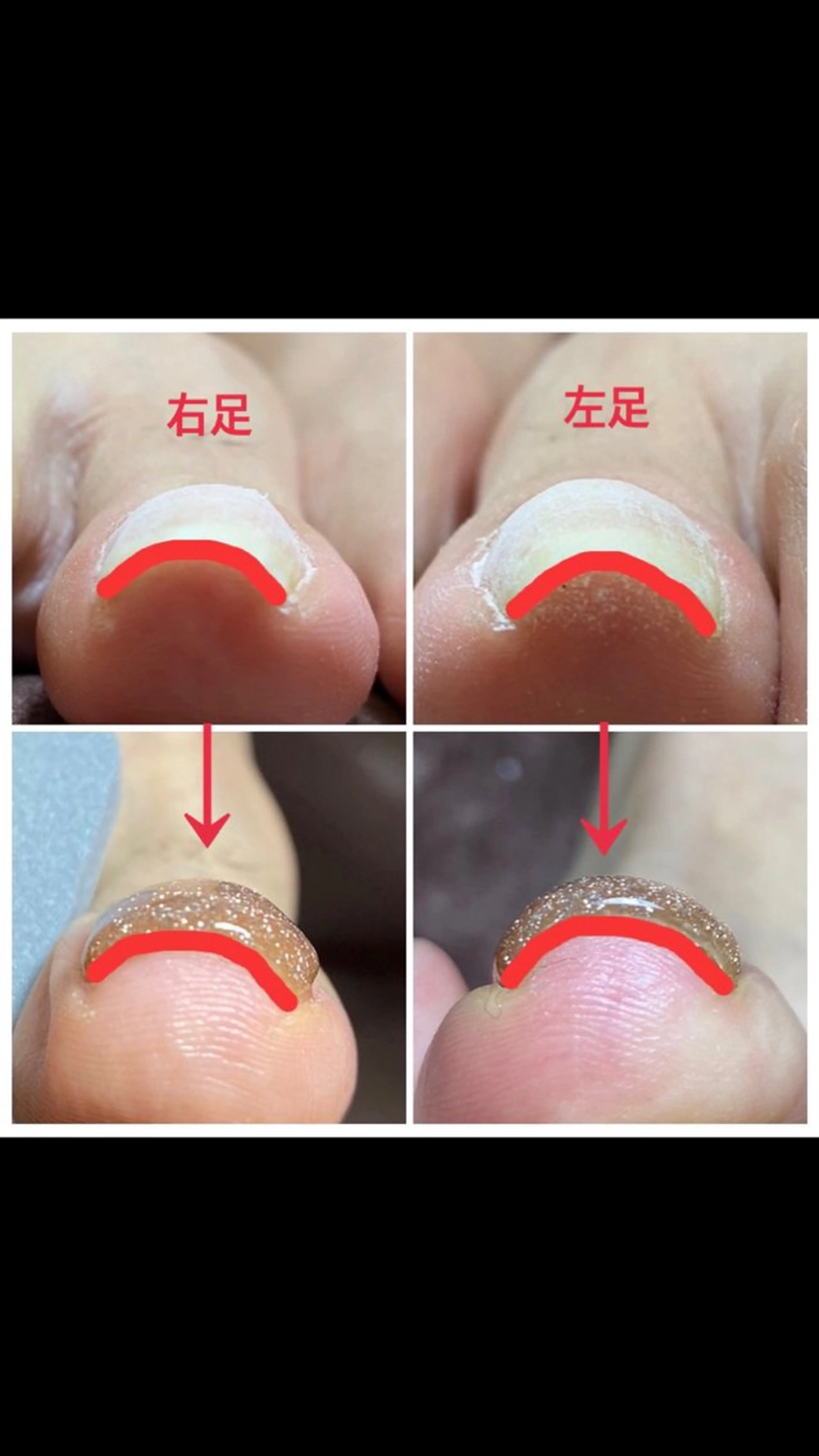 フット巻き爪・陥入爪対応(両親指) 90分の写真