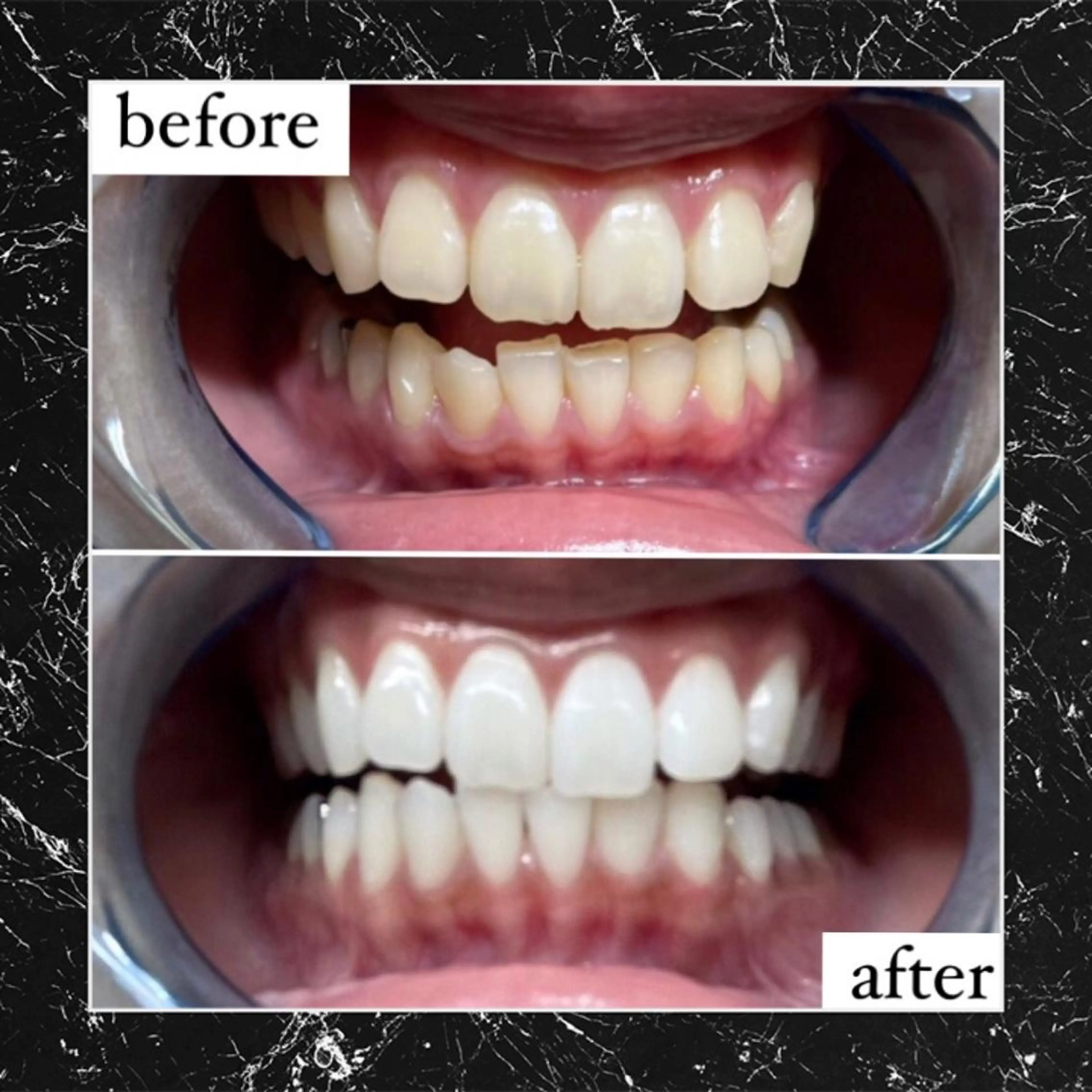 🌈一番人気🌈【🔥圧倒的効果！🔥】通常の6倍照射！【1日2名様まで】セルフホワイトニング✨イベント前にも🙆‍♀️の写真