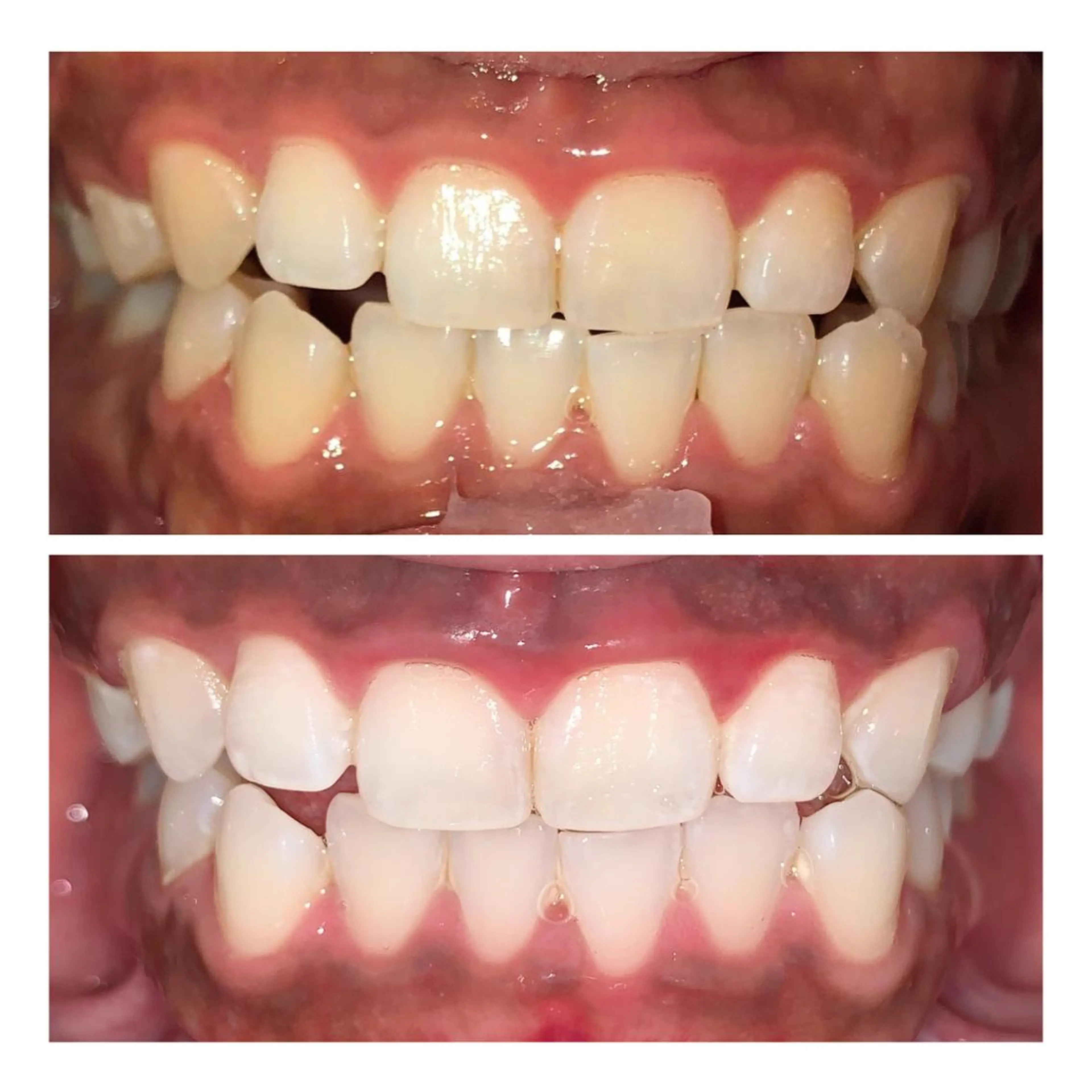 ホワイトニング｜韓国式3D毛穴洗浄 lonhana ﾛﾝﾊﾅ所属・韓国式3D毛穴洗浄 lonhanaのその他イメージ