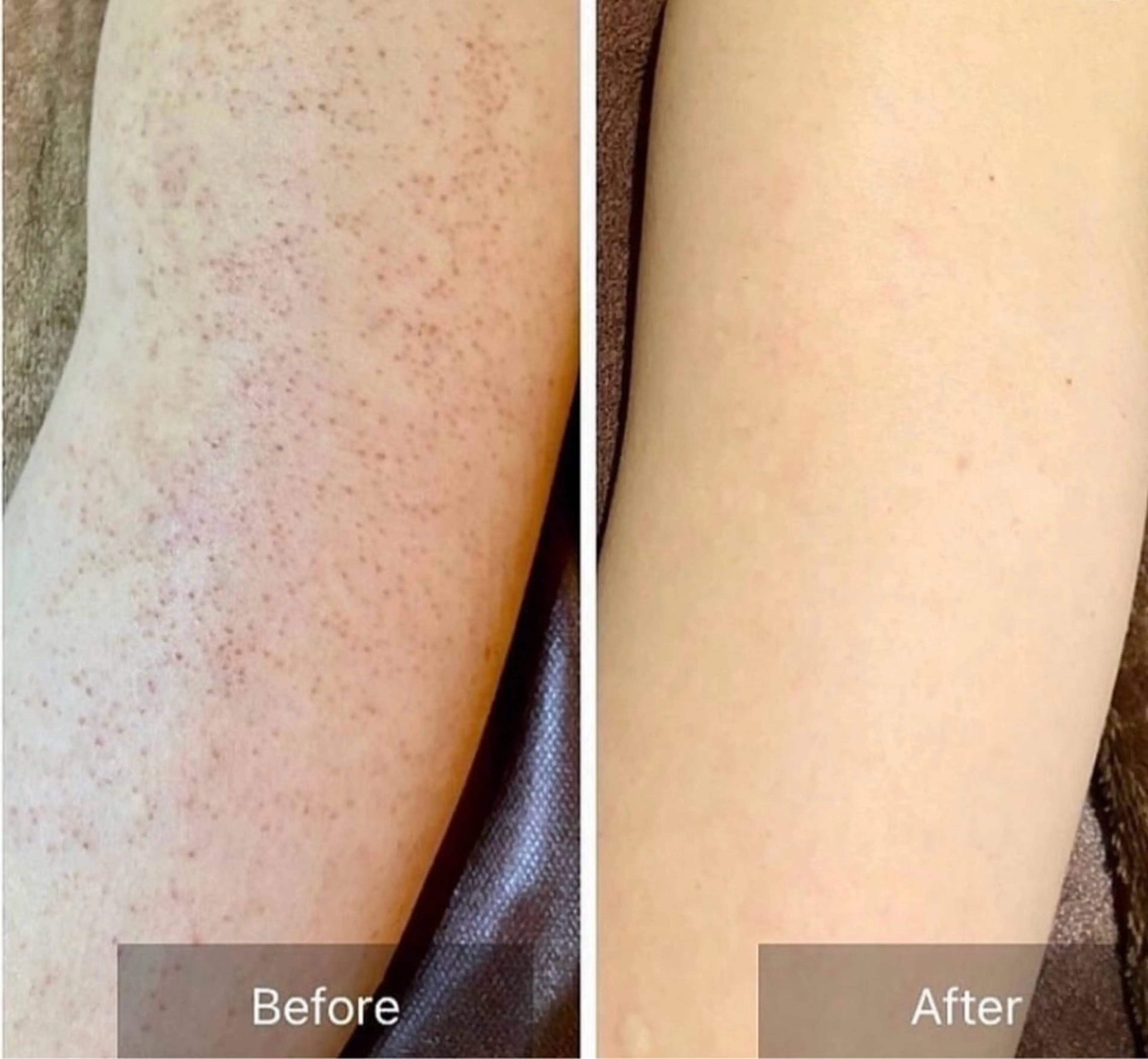 エミルカ　自由が丘店所属・ニキビ改善ハーブ🌿 ハナシマのその他イメージ