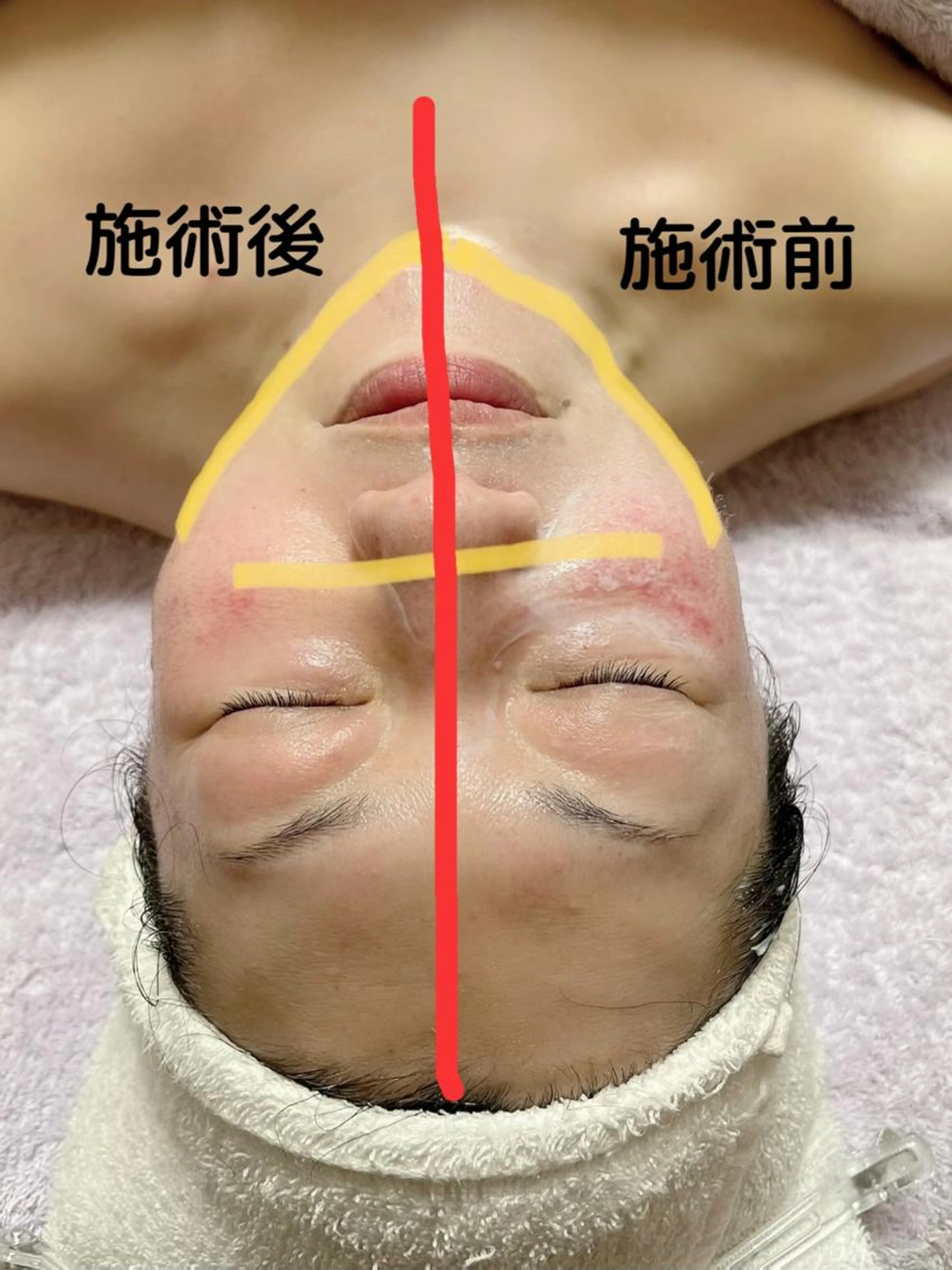 小顔エイジングケアコースの写真