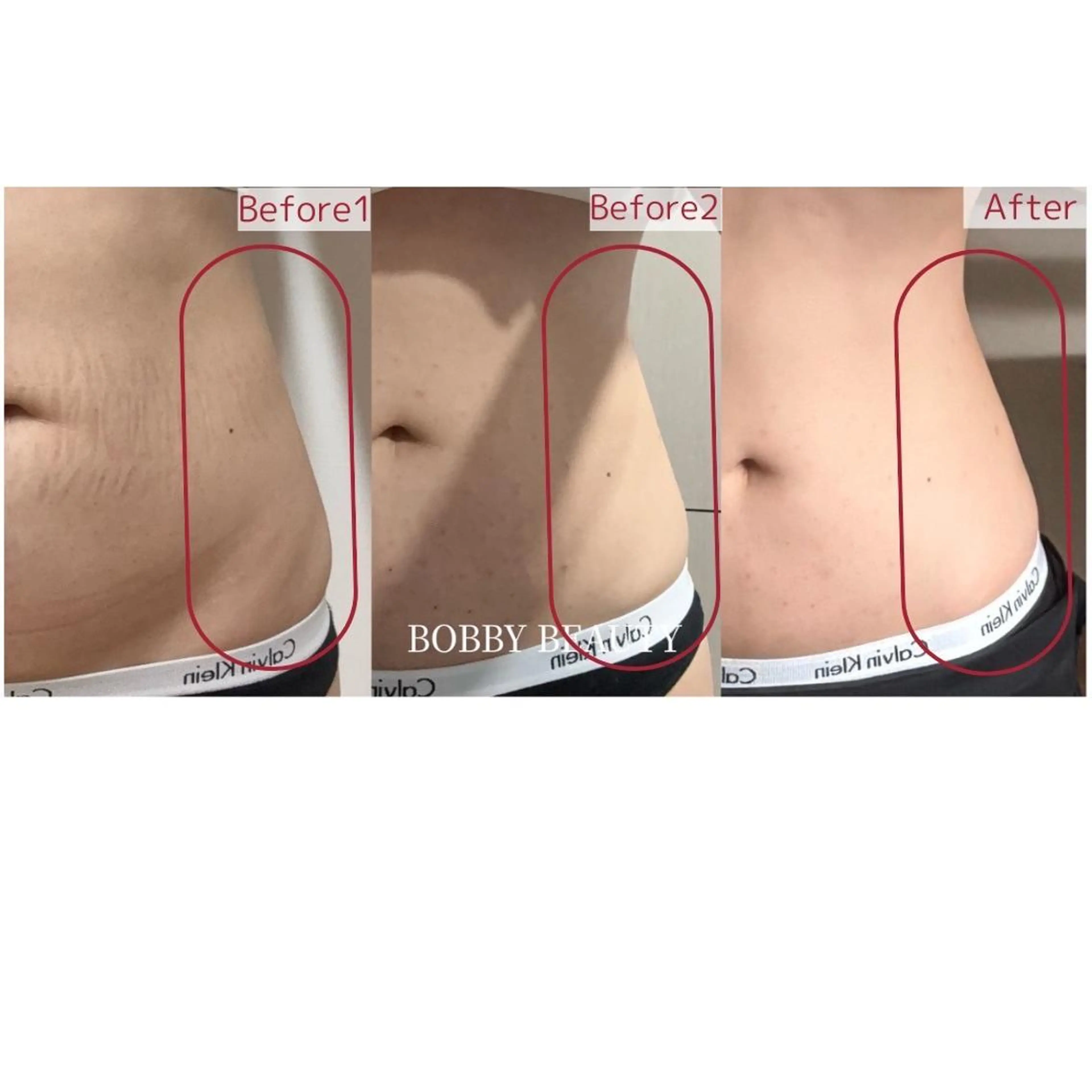 ☆脂肪にアプローチ☆　お腹の脂肪撃退　RedShot１０cc導入　理想のボディメイクを加速！の写真