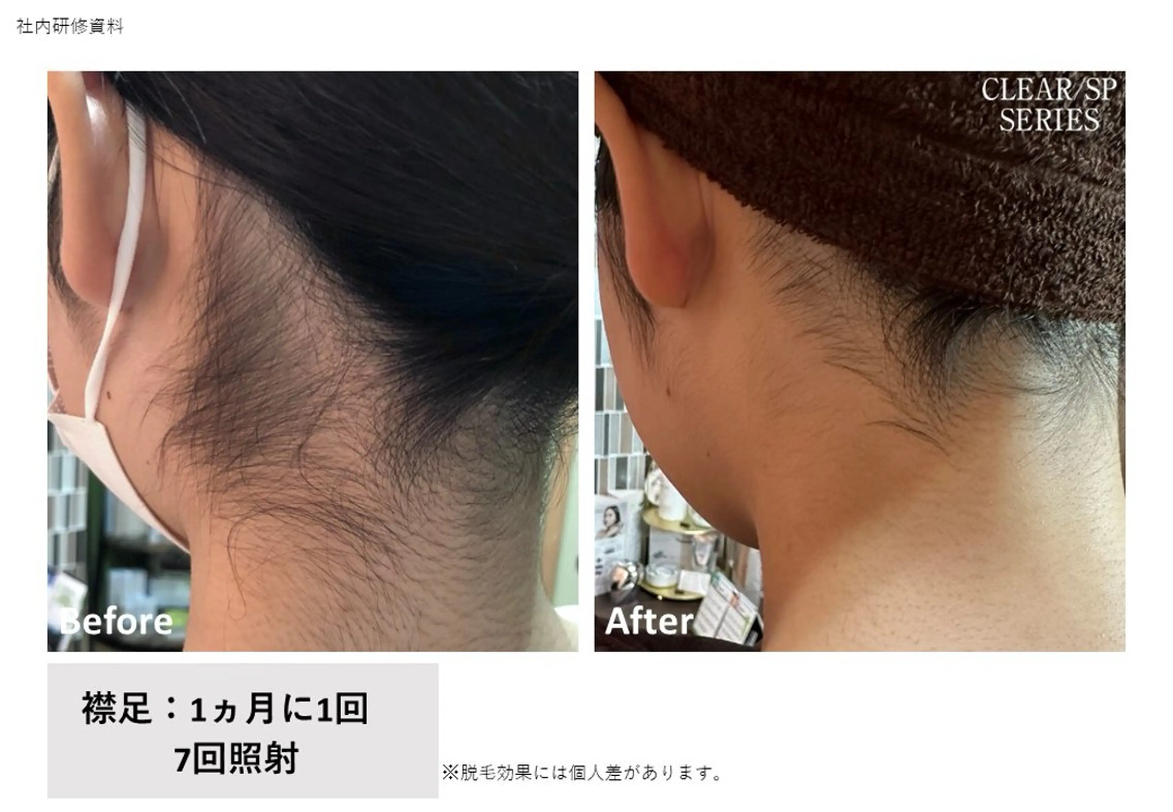 脱毛 野口 茂宰のヘアスタイル