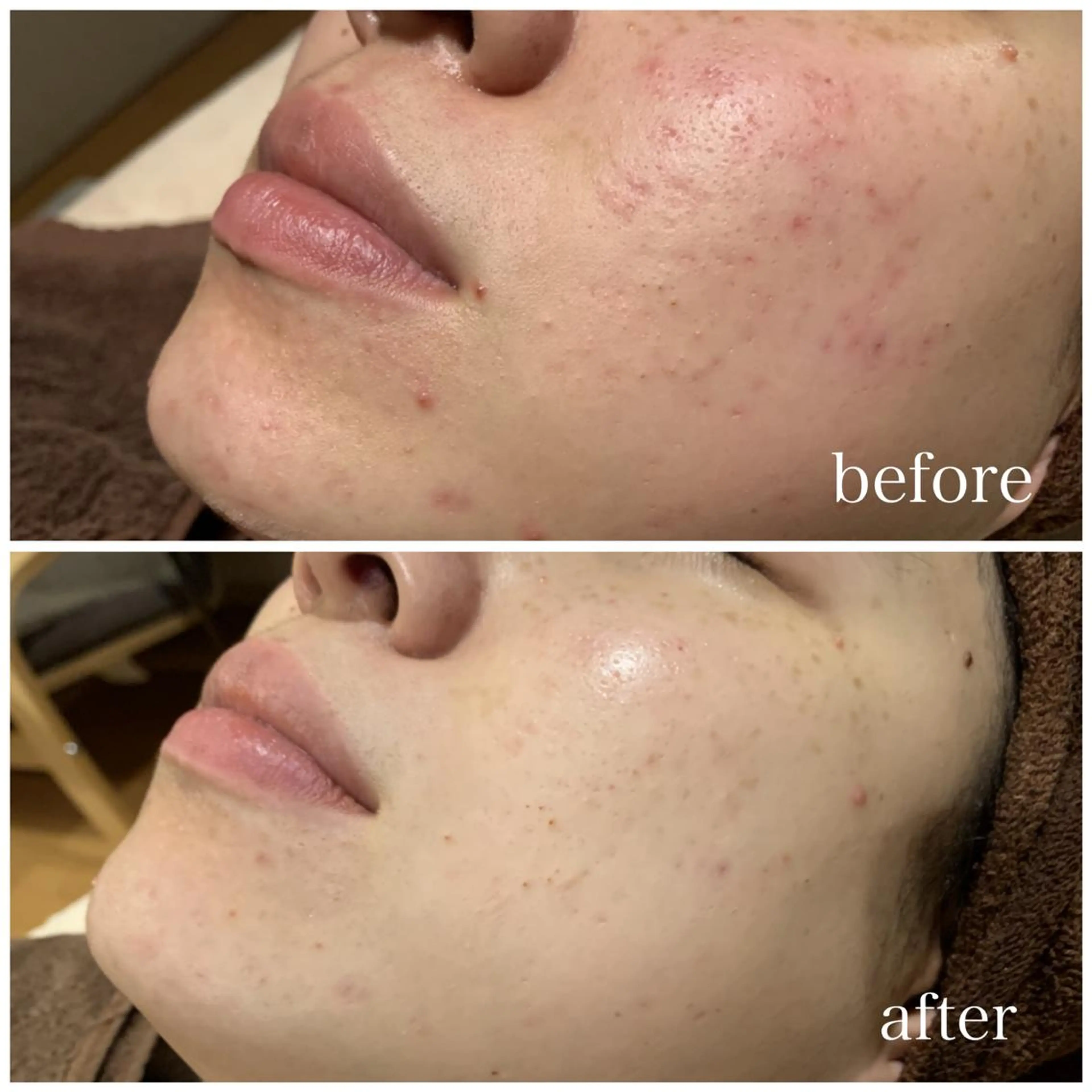 【初めての方はコチラ】本気の肌改善　初回カウンセリング込　￥16500​〜​の写真