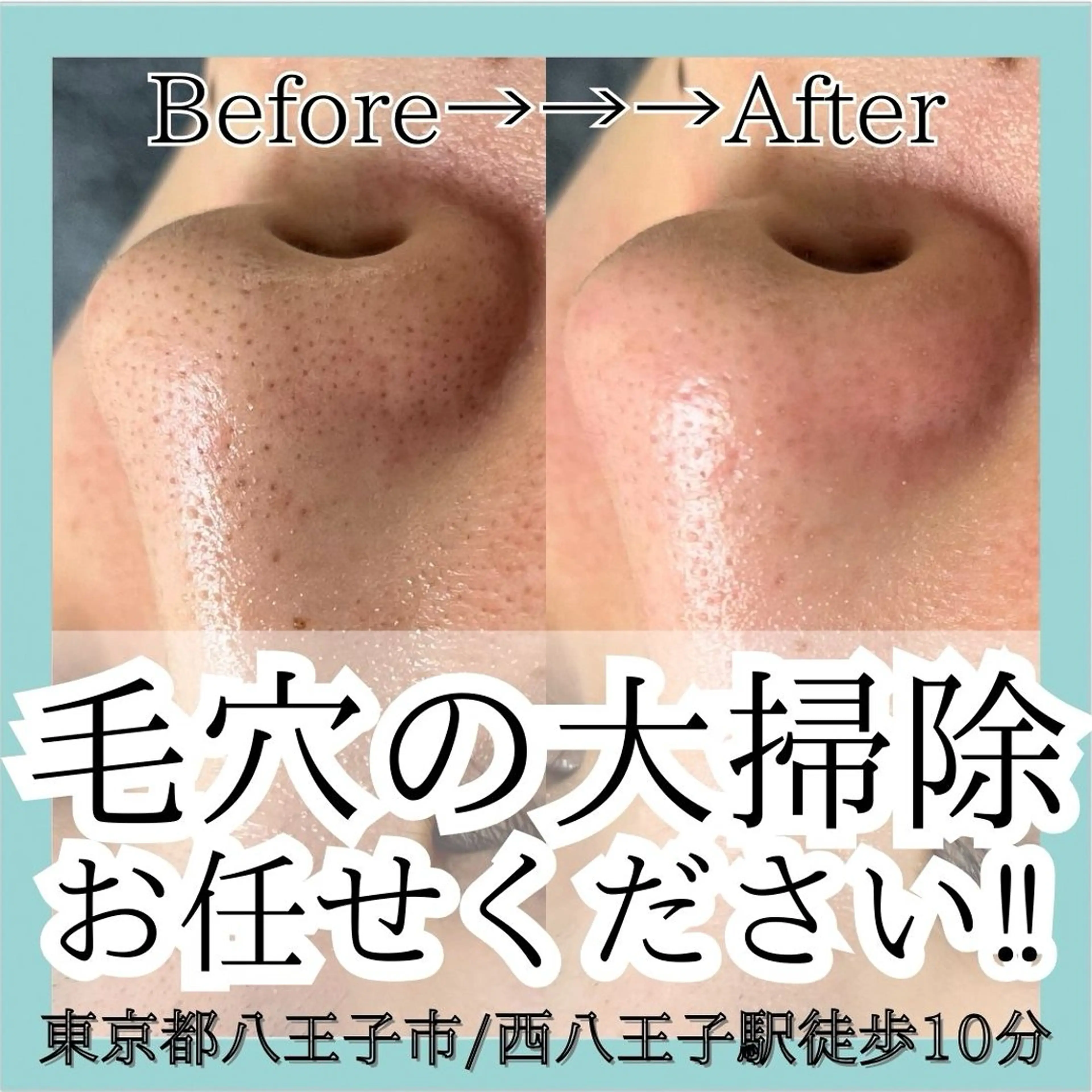 ＼ミニモ学割／人気No.1メニュー❣️【💆🏻‍♀️毛穴洗浄コース💎】の写真