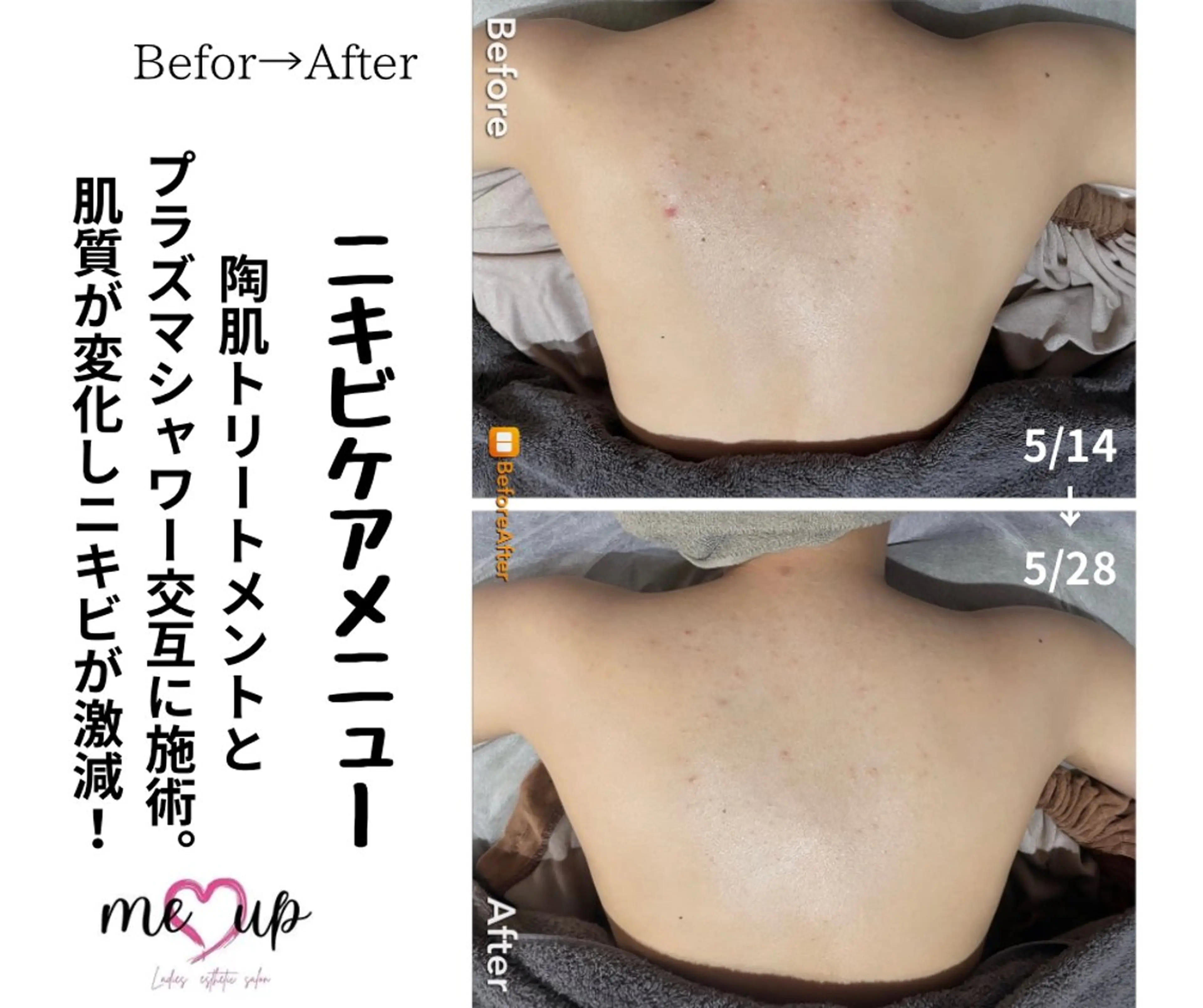 エステ Meupニキビ専門店 背中/ハーブ/肌管理のその他イメージ