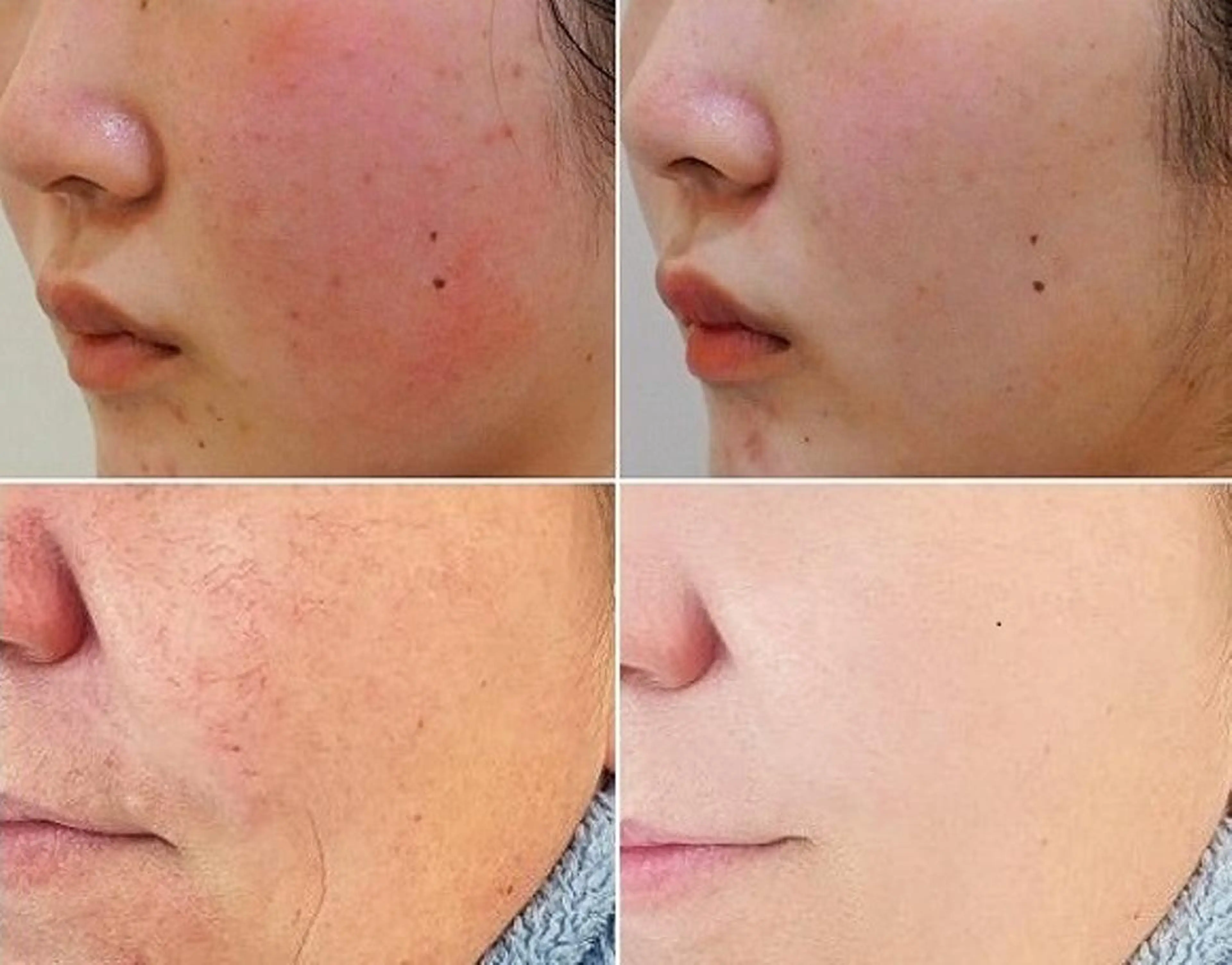 【美容顔脱毛】+【赤ら顔ケア】エステ唯一の抜けと美肌&4種の美容特許フェイシャルで肌修正の写真