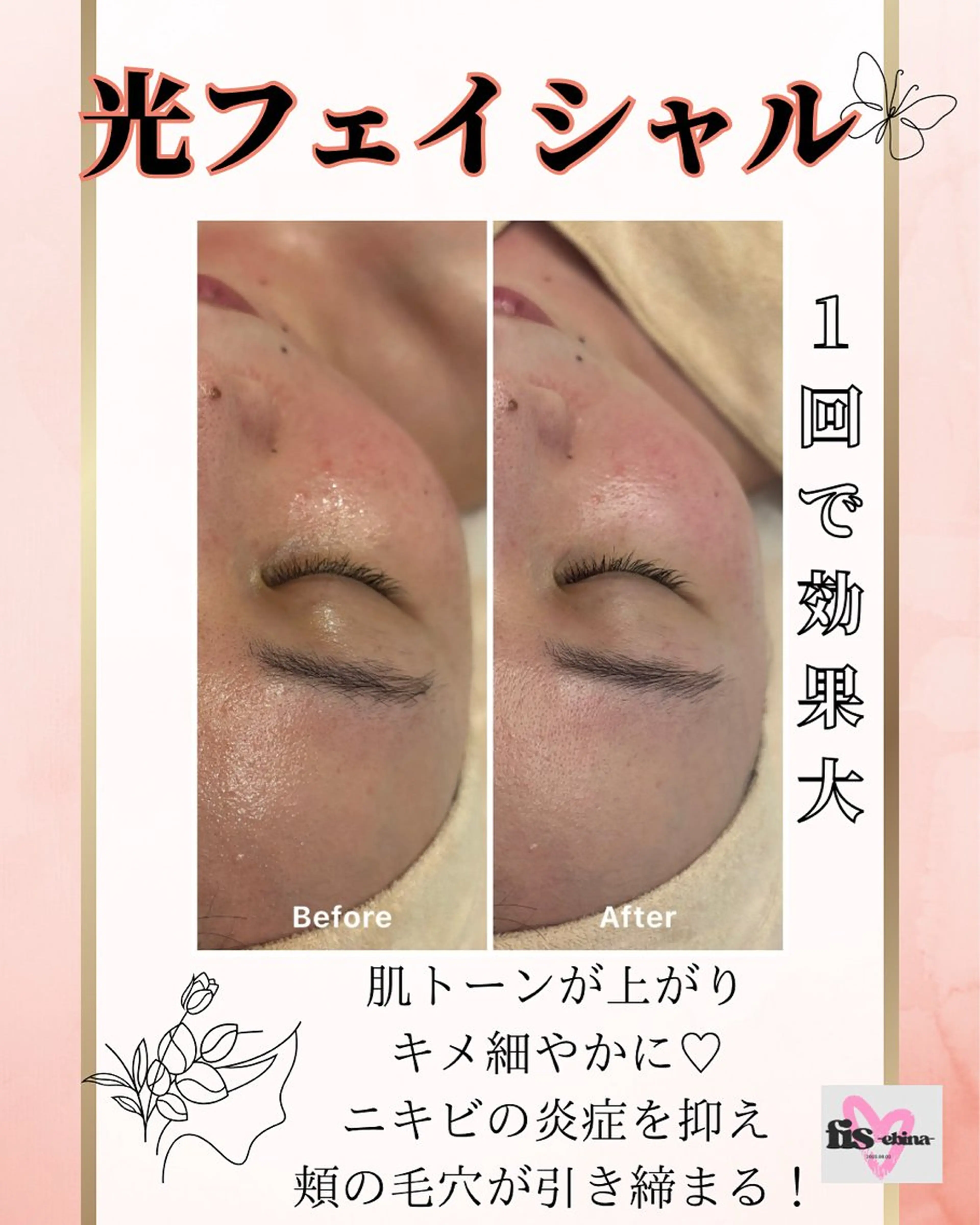 【新規】美肌光ケアの写真