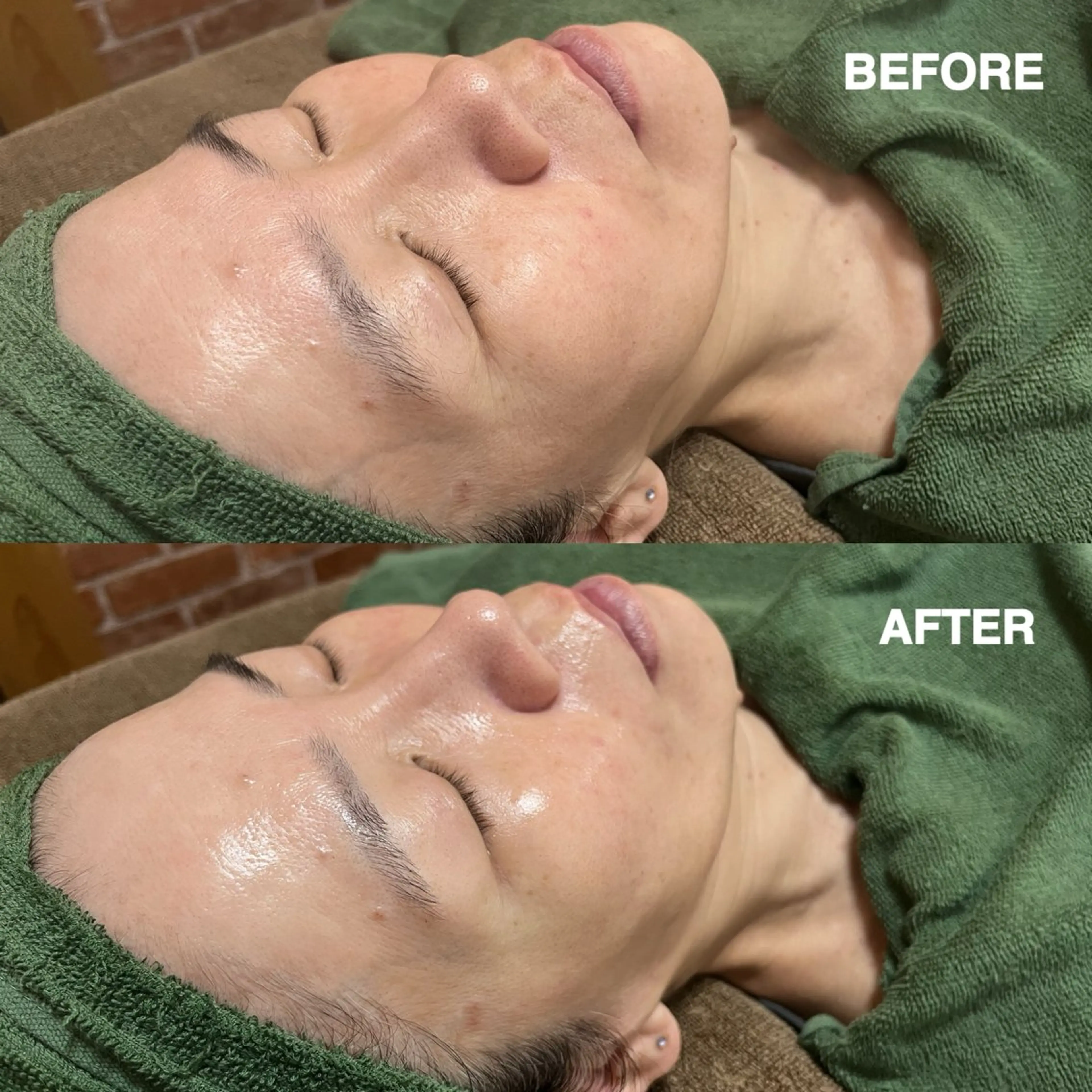 【お肌悩みに合わせてカスタマイズ🌿】　　　　　　　　✳︎シェービング＋肌再生生パックの写真