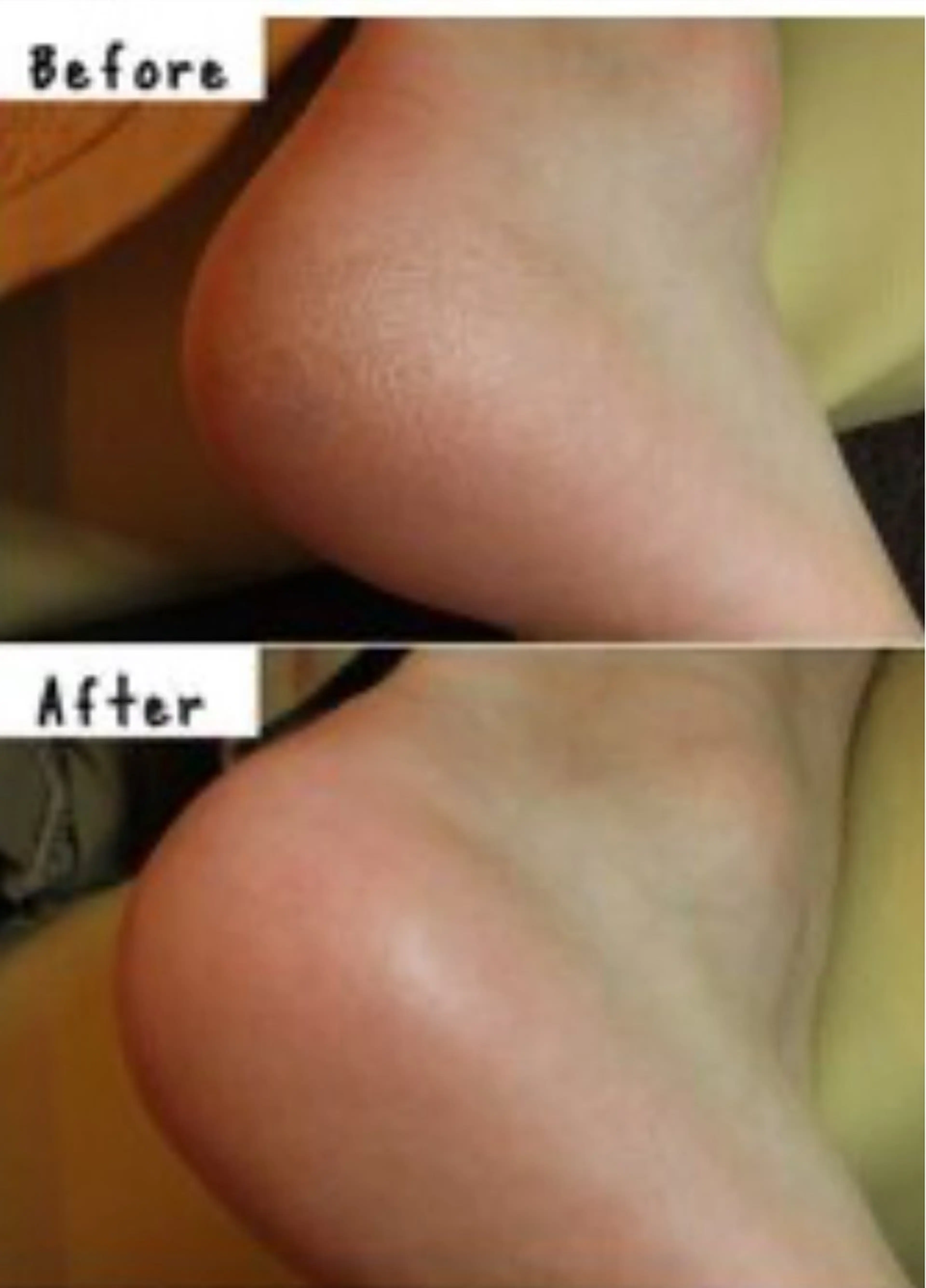 🌸足裏角質ケア🌸両足のガザガサかかとを綺麗にしましょう✨の写真