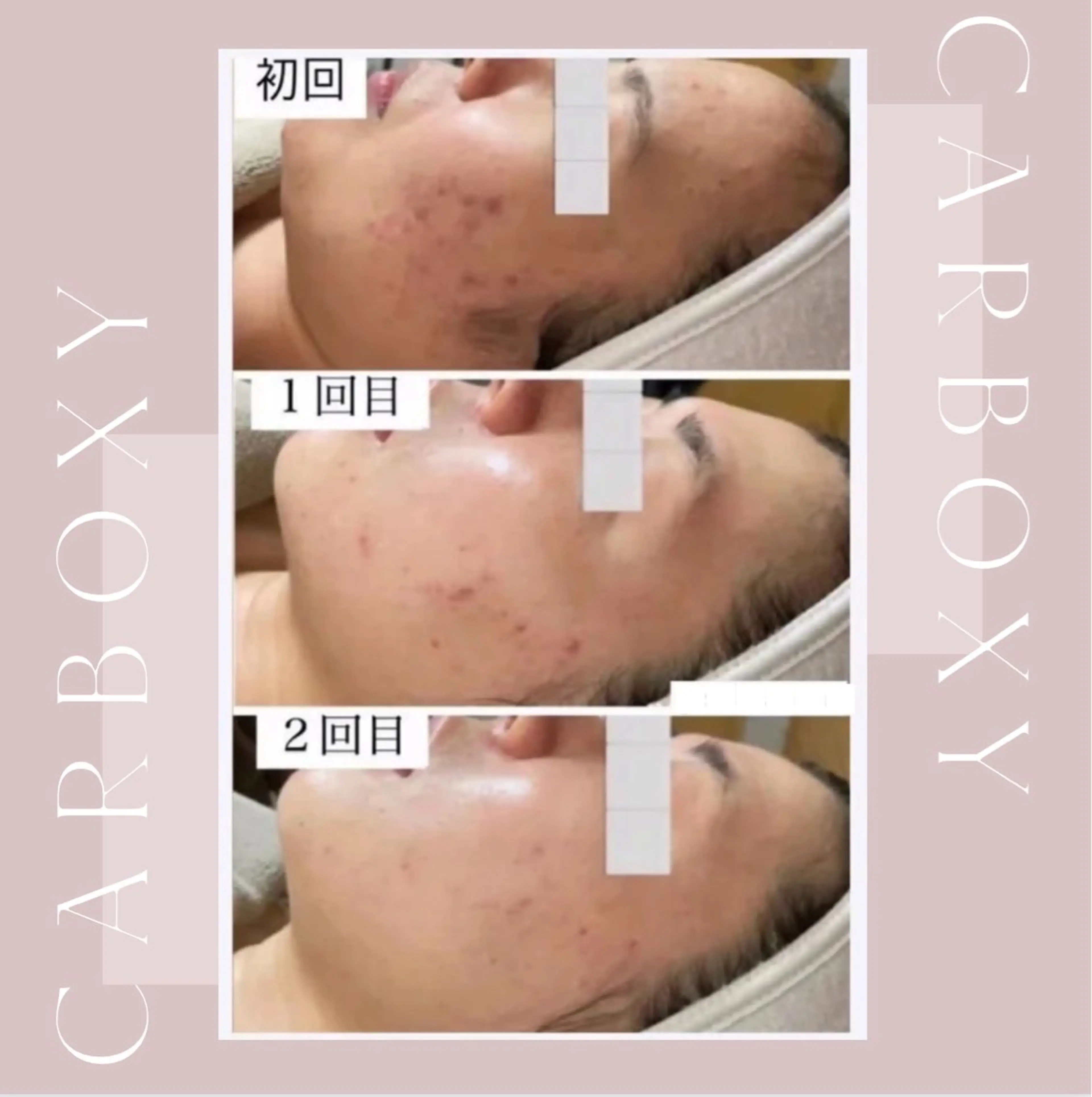 エステ 艶肌ワックス ALLY.のエステ・リラクイメージ