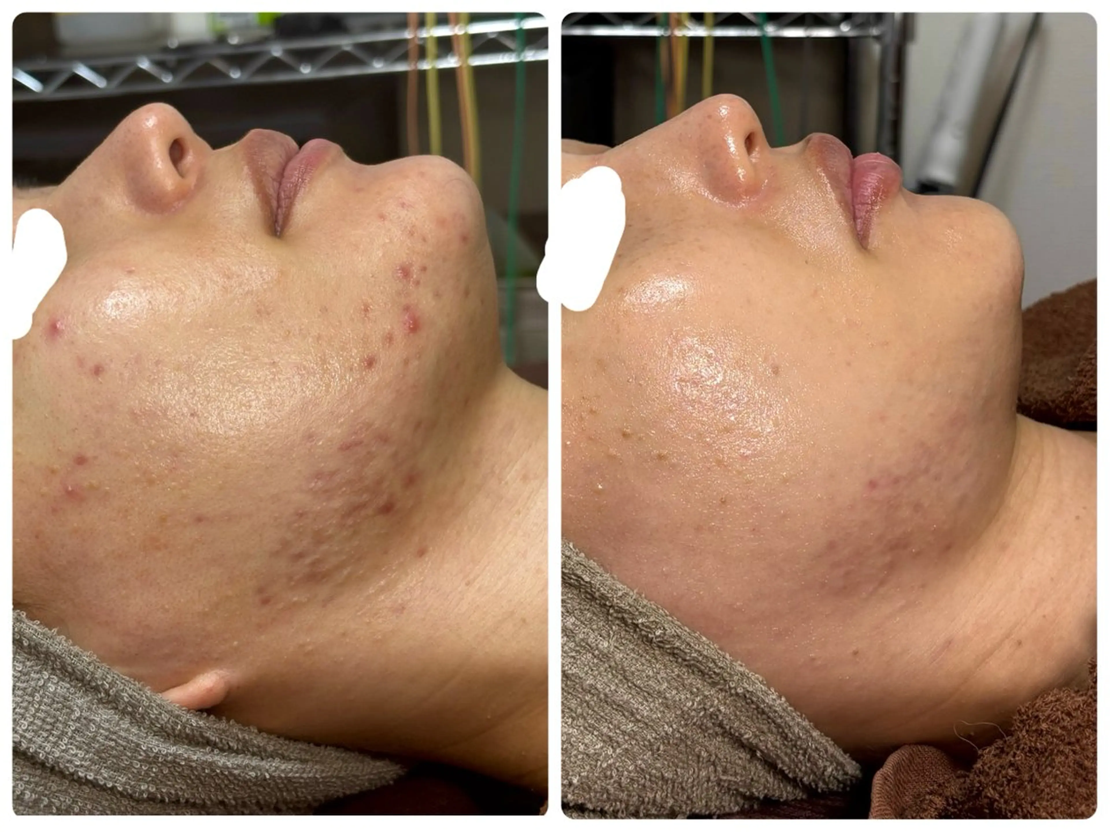 エステ 小顔ハーブピーリング 美容鍼/毛穴洗浄のエステ・リラクイメージ