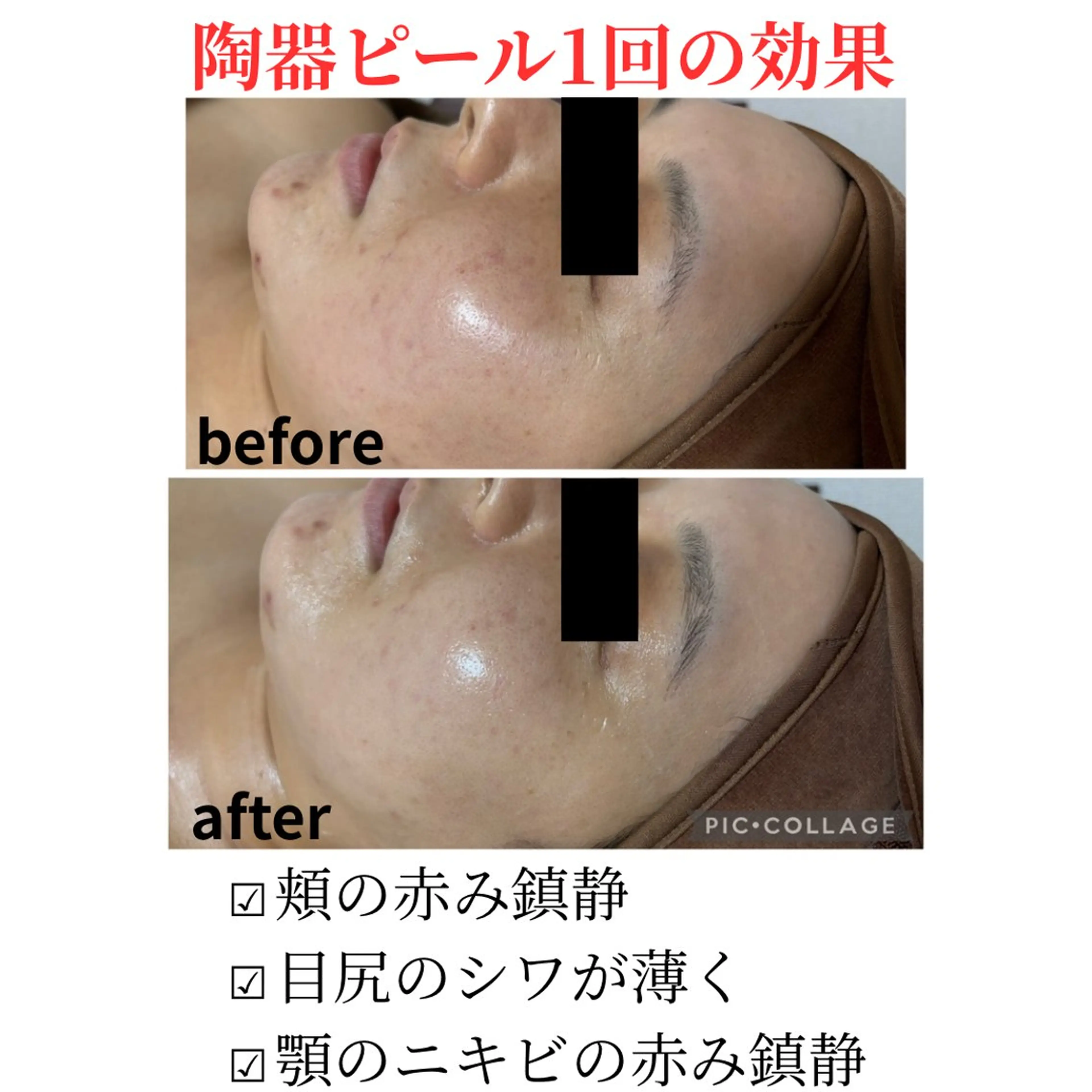 《ニキビ毛穴レスツヤ肌コース》の写真