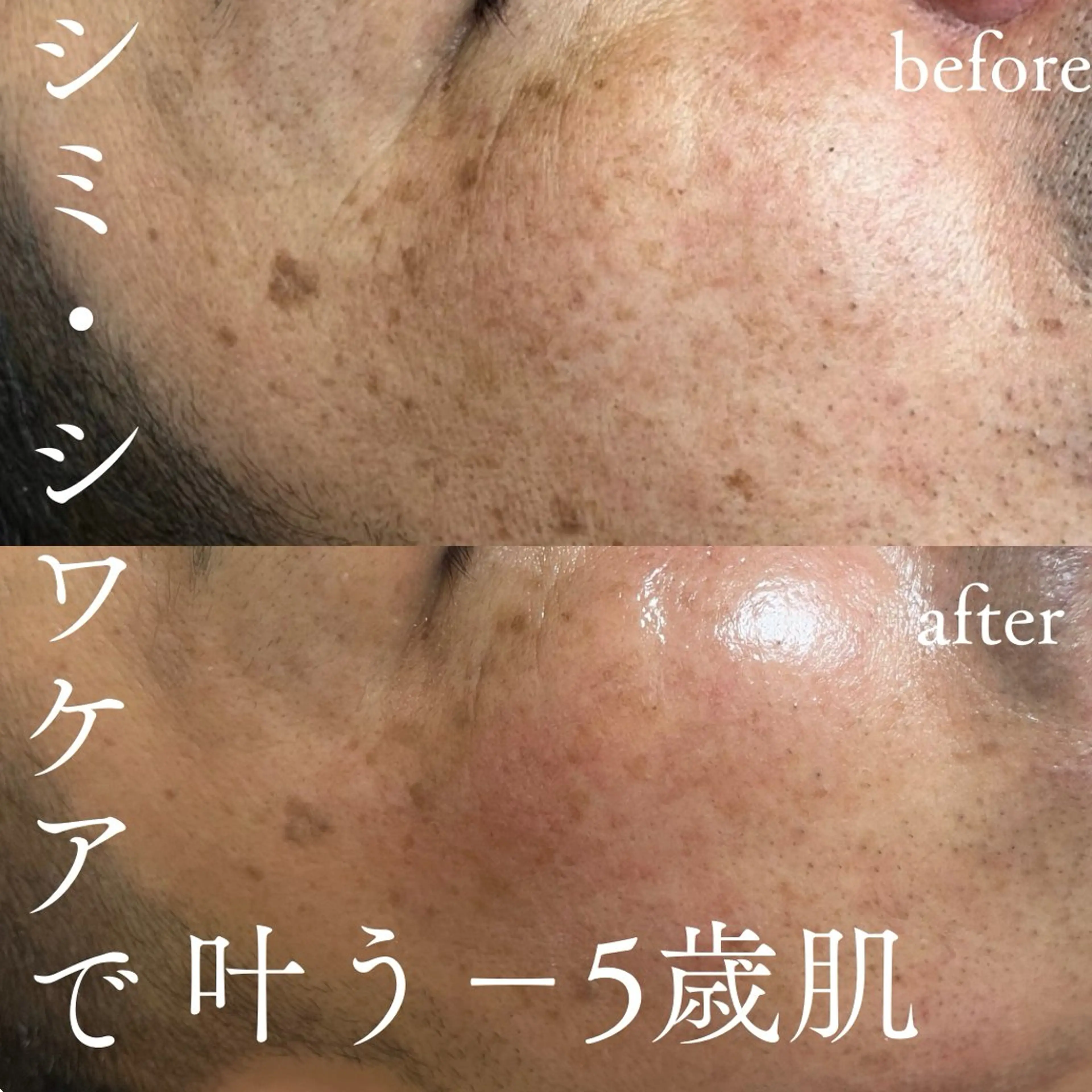 【ノーファンデツヤ肌】ハーブトリートメント(キメを整え驚きのツヤ肌に！)※毛穴ケアオプション込の写真