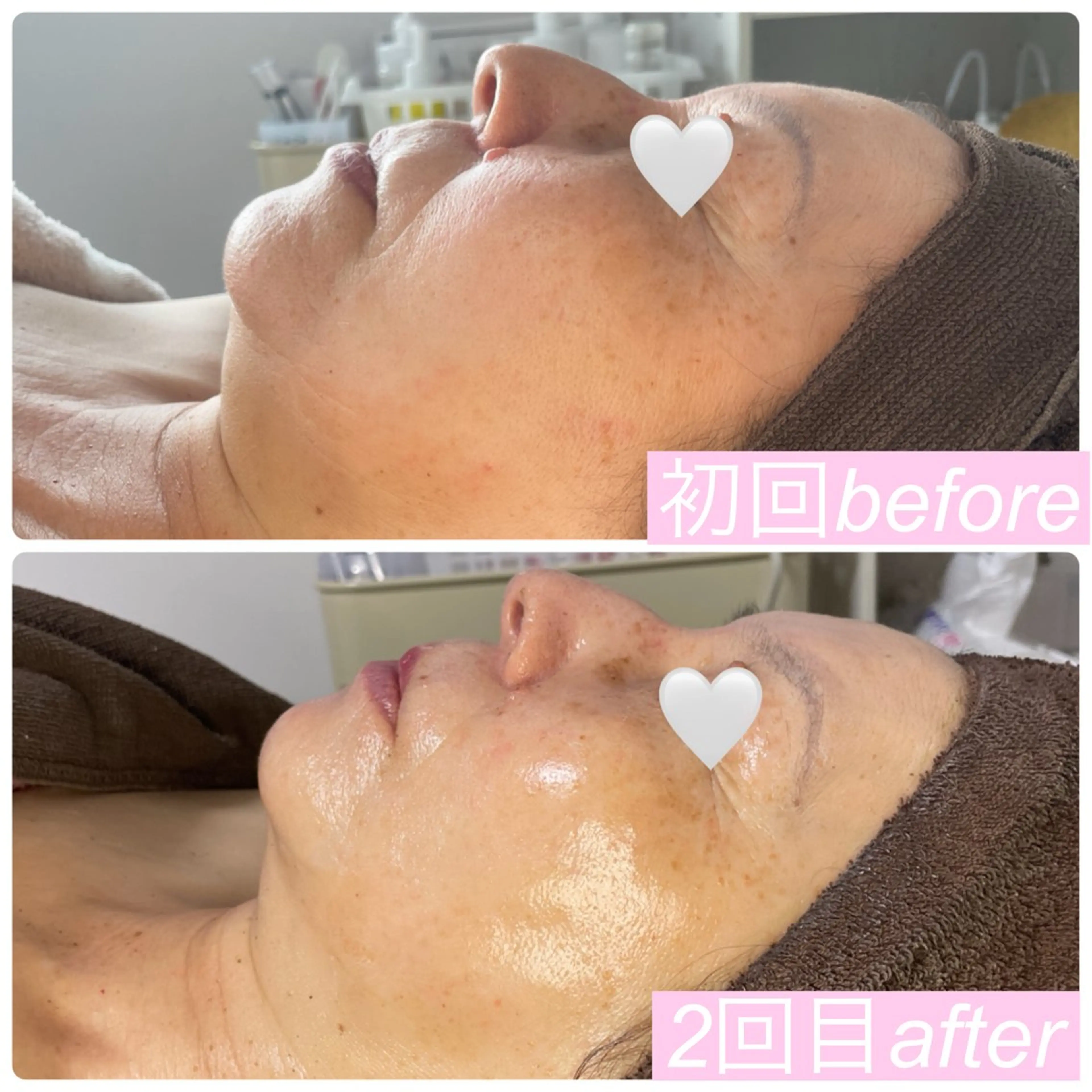 エステ 肌育脱毛サロン LikoLinaのその他イメージ