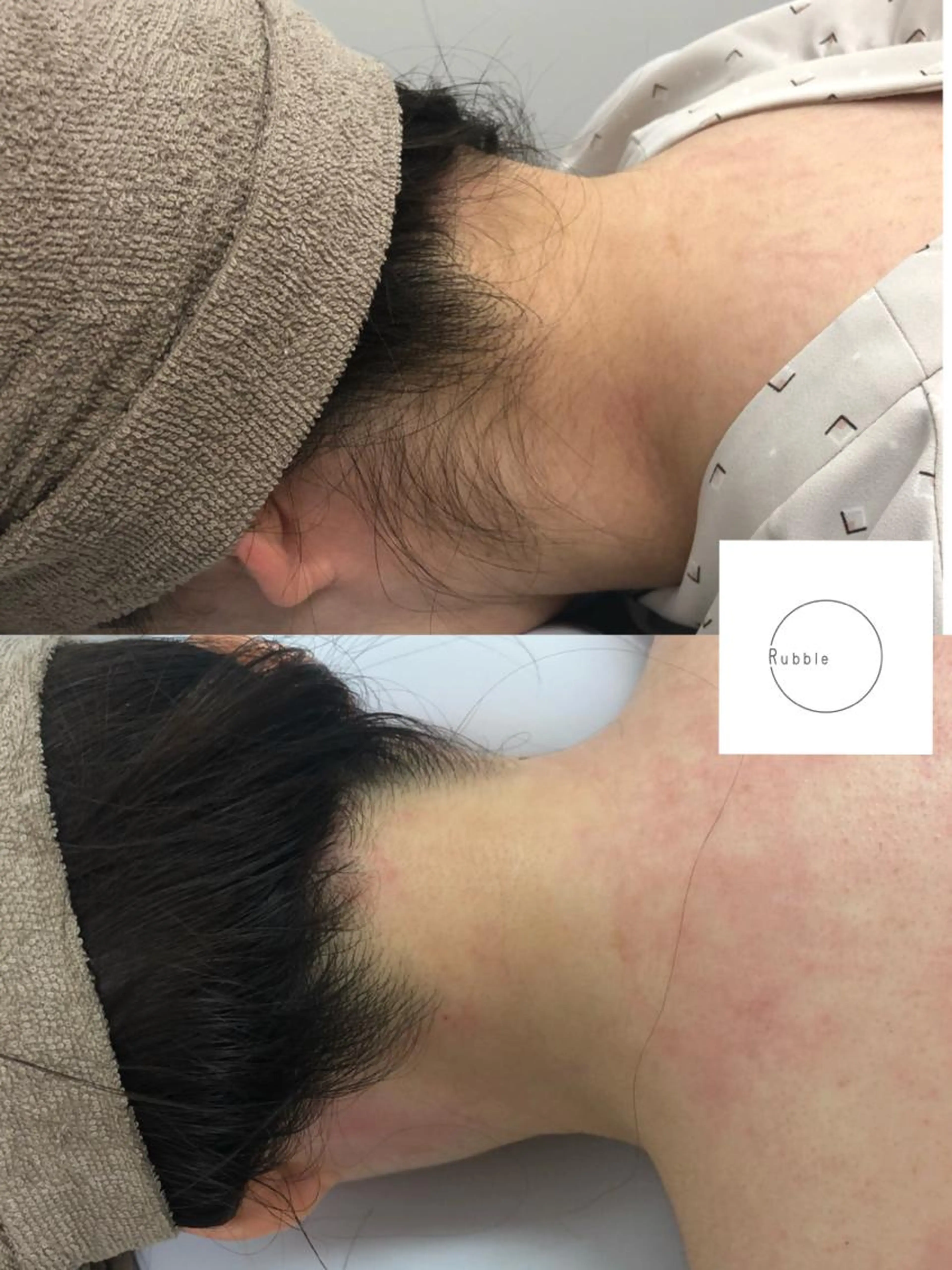 うなじ＆背中(上半分)wax脱毛の写真