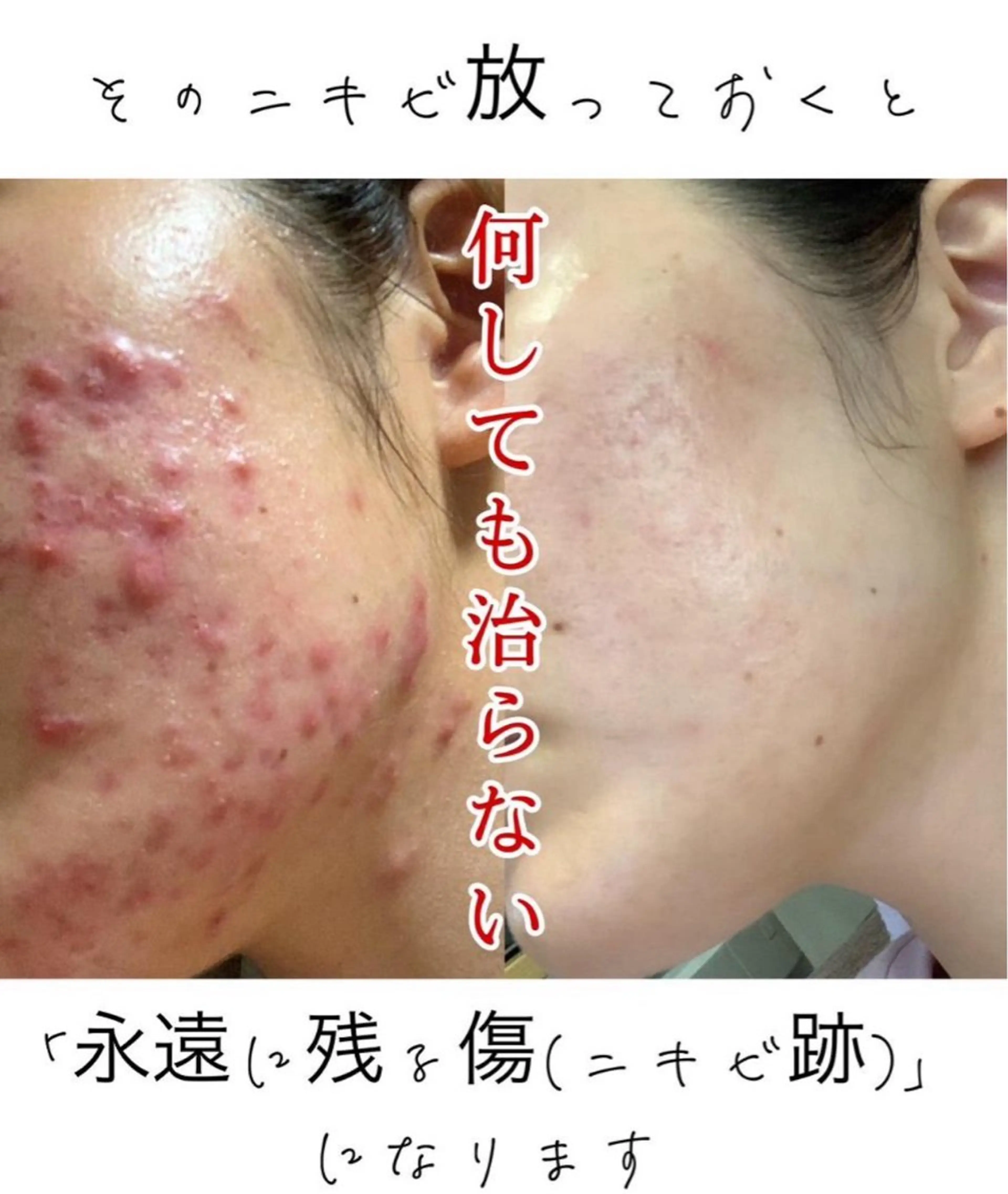 【本気改善】剥離あり韓国水光肌ハーブピーリング 27,500→8,800円※メッセージにてご予約確定※の写真