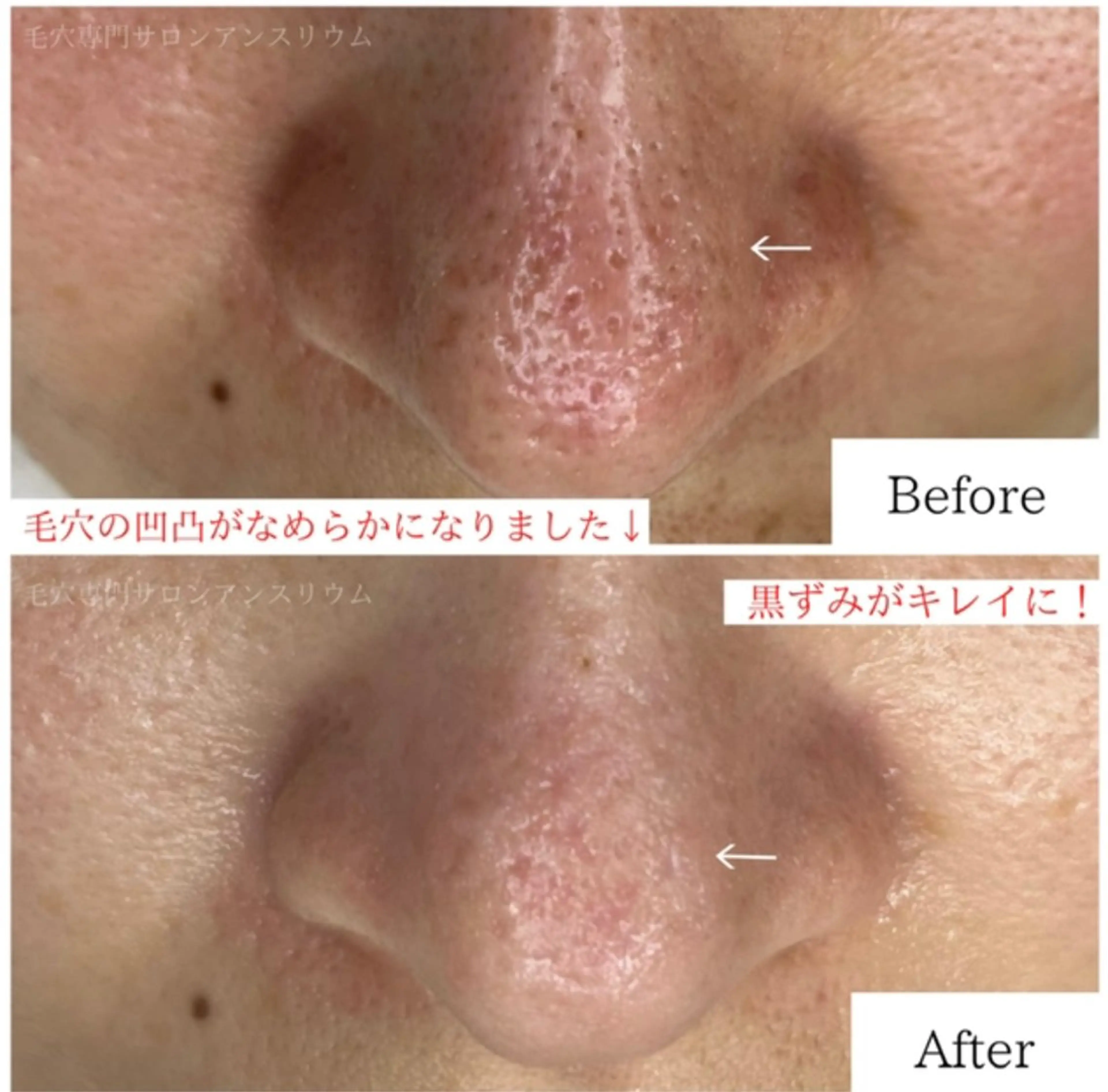 毛穴ケア専門サロンアンスリウム所属・茨城土浦 つくば毛穴 ケア専門サロンのエステ・リラクイメージ