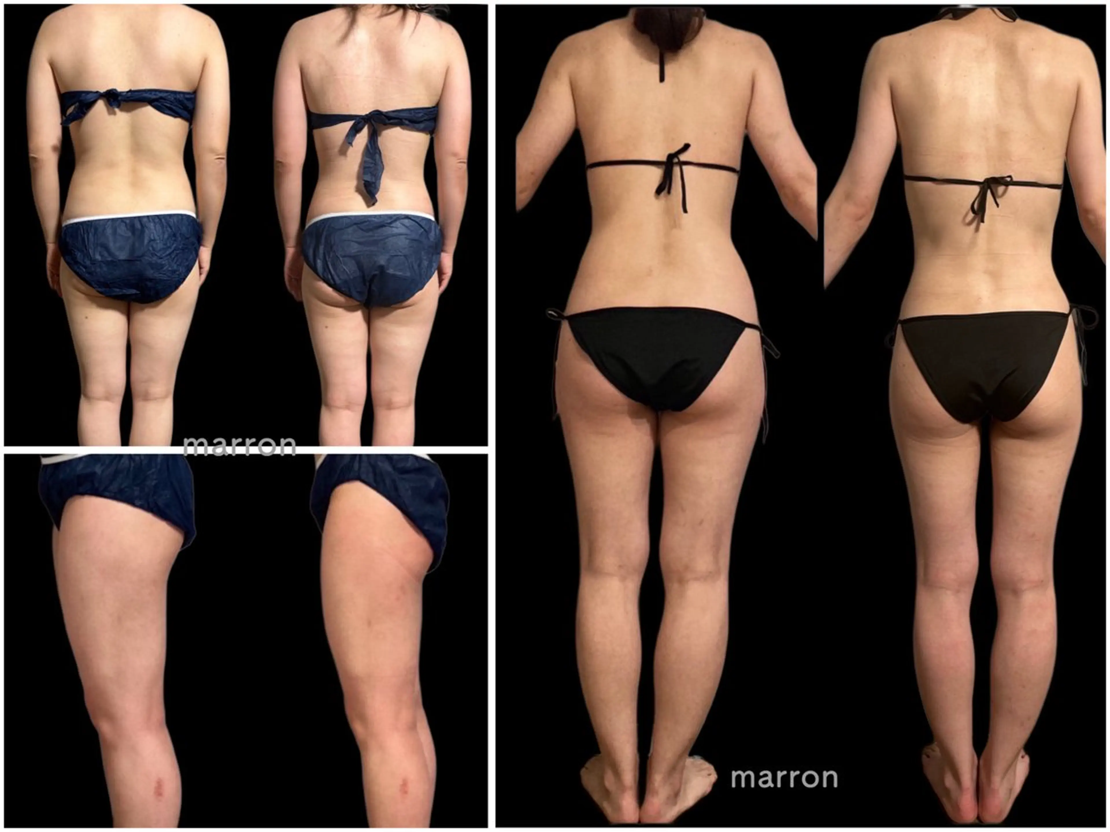 marron所属・痩身ハイパーナイフ ララピールリアボーテのエステ・リラクイメージ