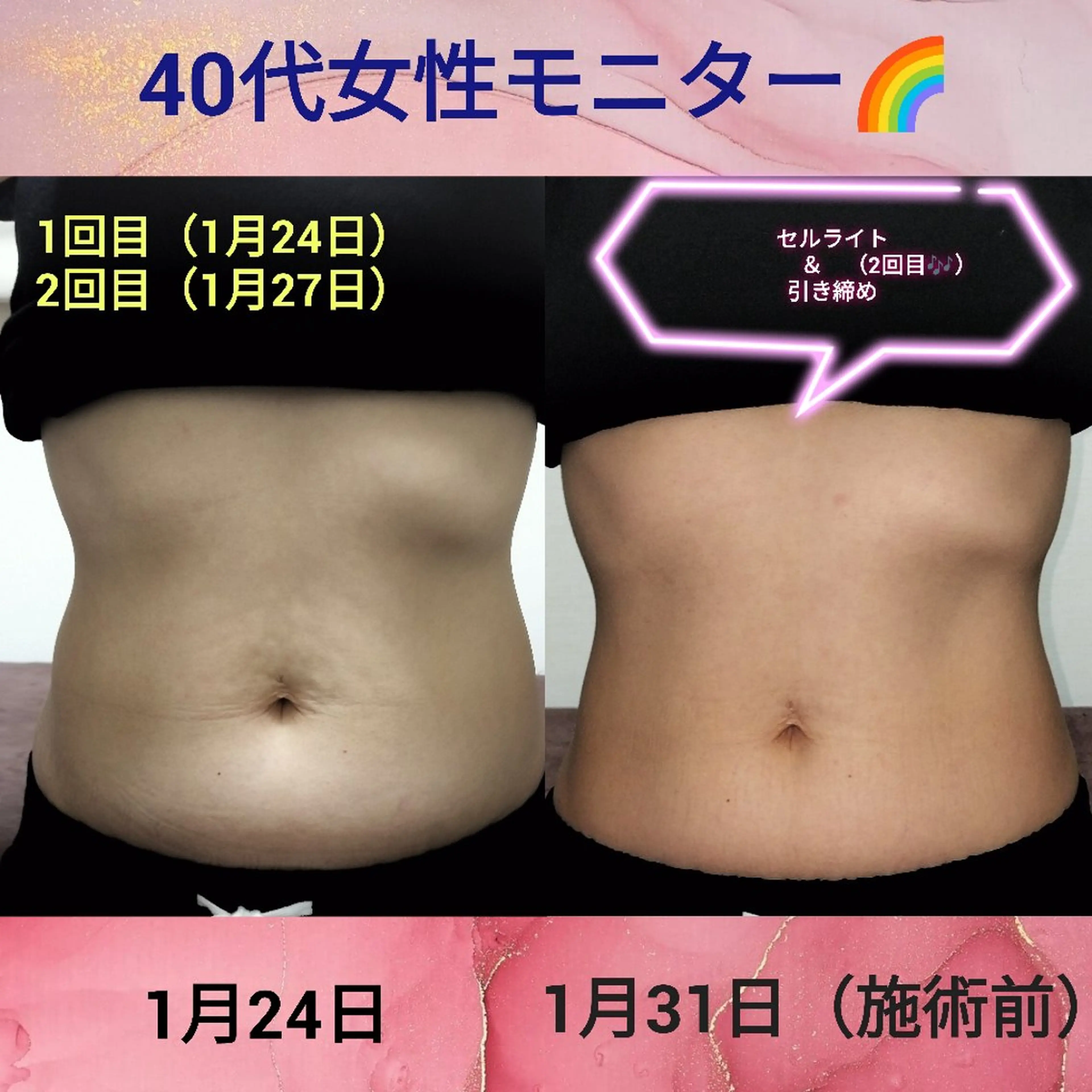 女性OK!🌈【12650円→8800円】テスラシェイプ1箇所30分＆自宅ケアクリーム付【定価9350円】の写真