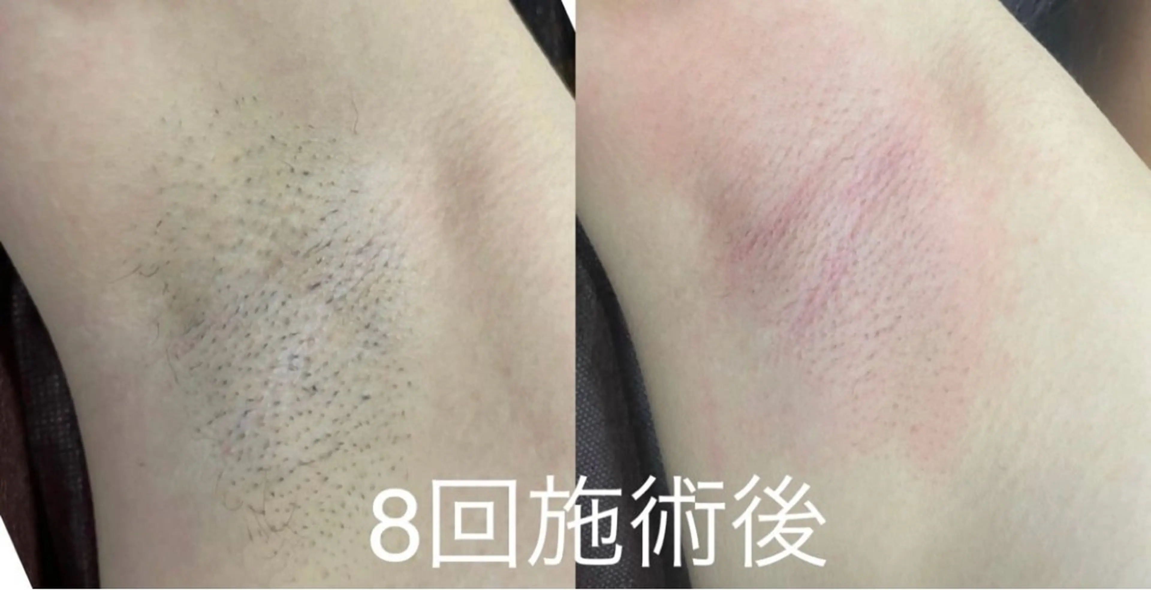 全身脱毛(ドイツ製のハイブリッド機使用)1回で効果を実感できます！是非お試し下さい！こちらは初回のみになります。の写真