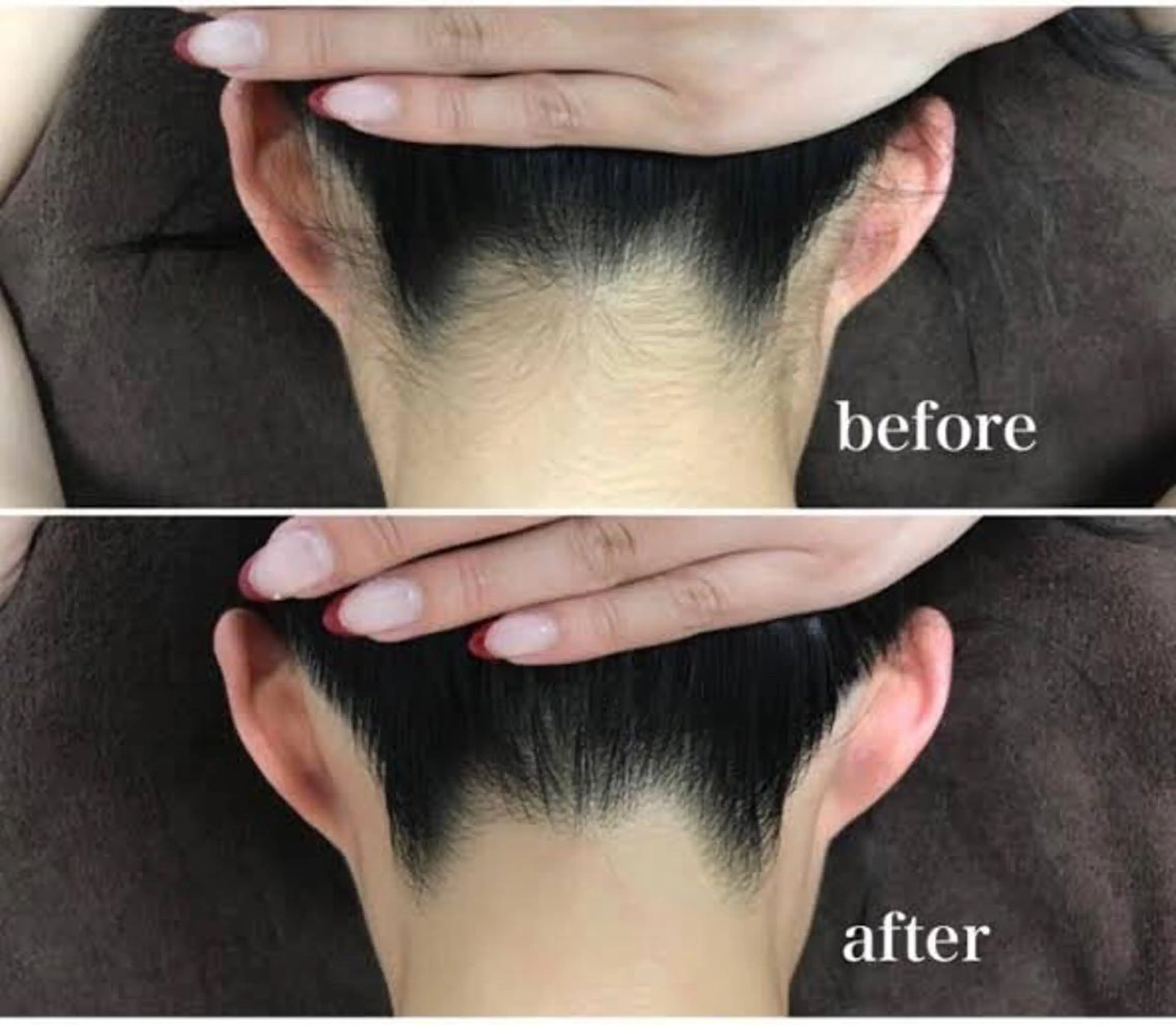 【意外と見られてる☆後ろ姿も美人に】うなじ脱毛2回セットの写真