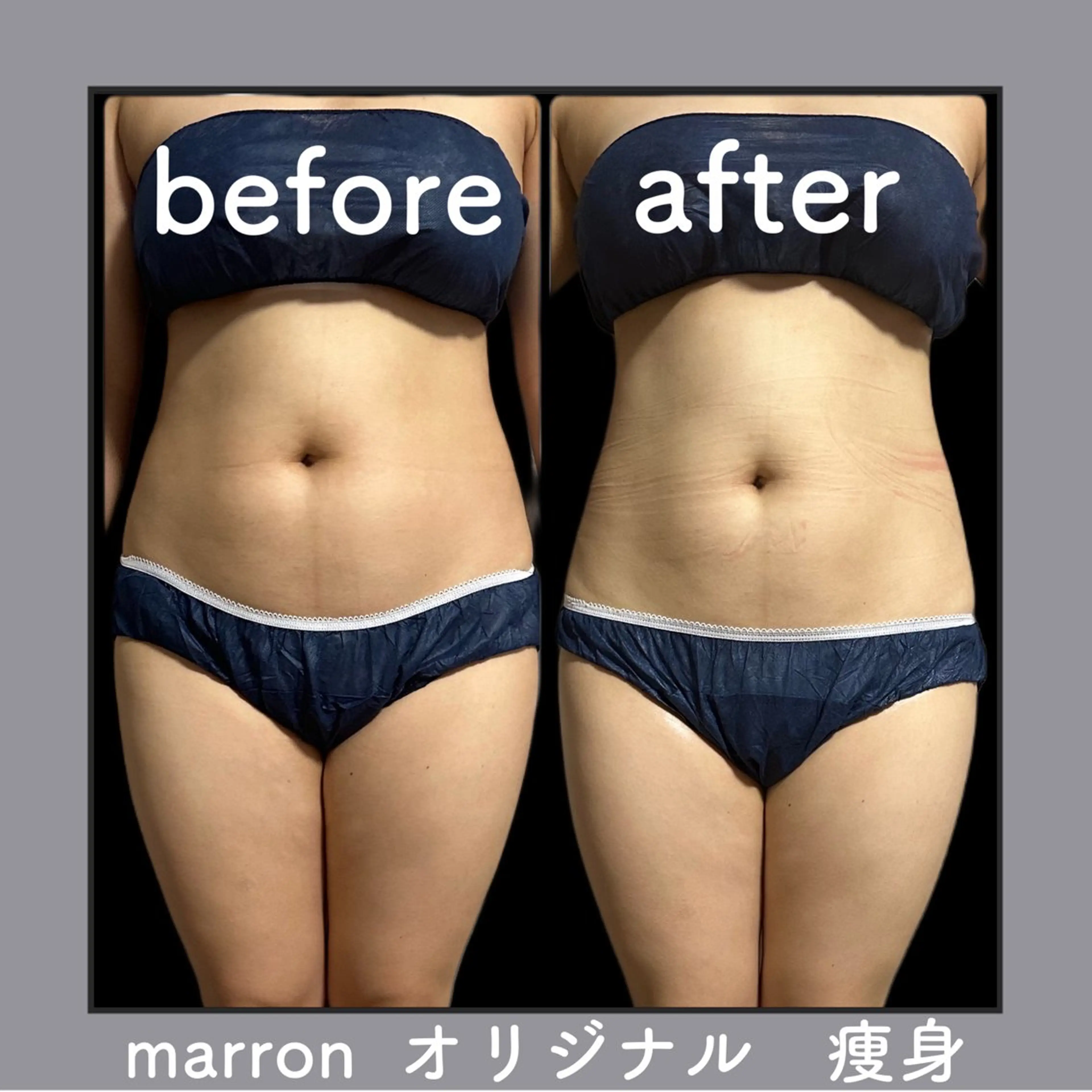 marron所属・痩身ハイパーナイフ ララピールリアボーテのエステ・リラクイメージ