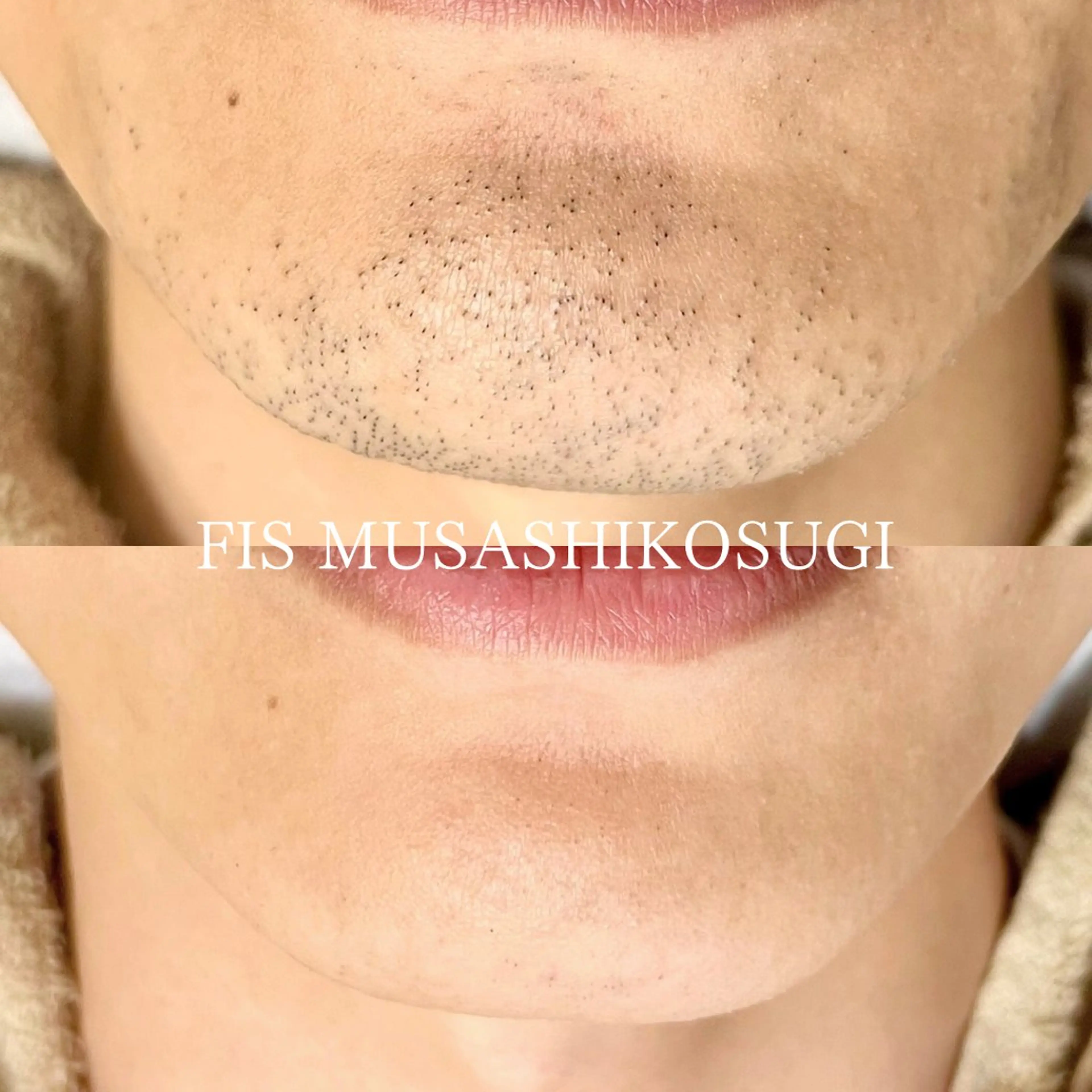 脱毛 脱毛サロン&ハーブピーリングFIS武蔵小杉店所属・脱毛サロン FIS武蔵小杉店のエステ・リラクイメージ