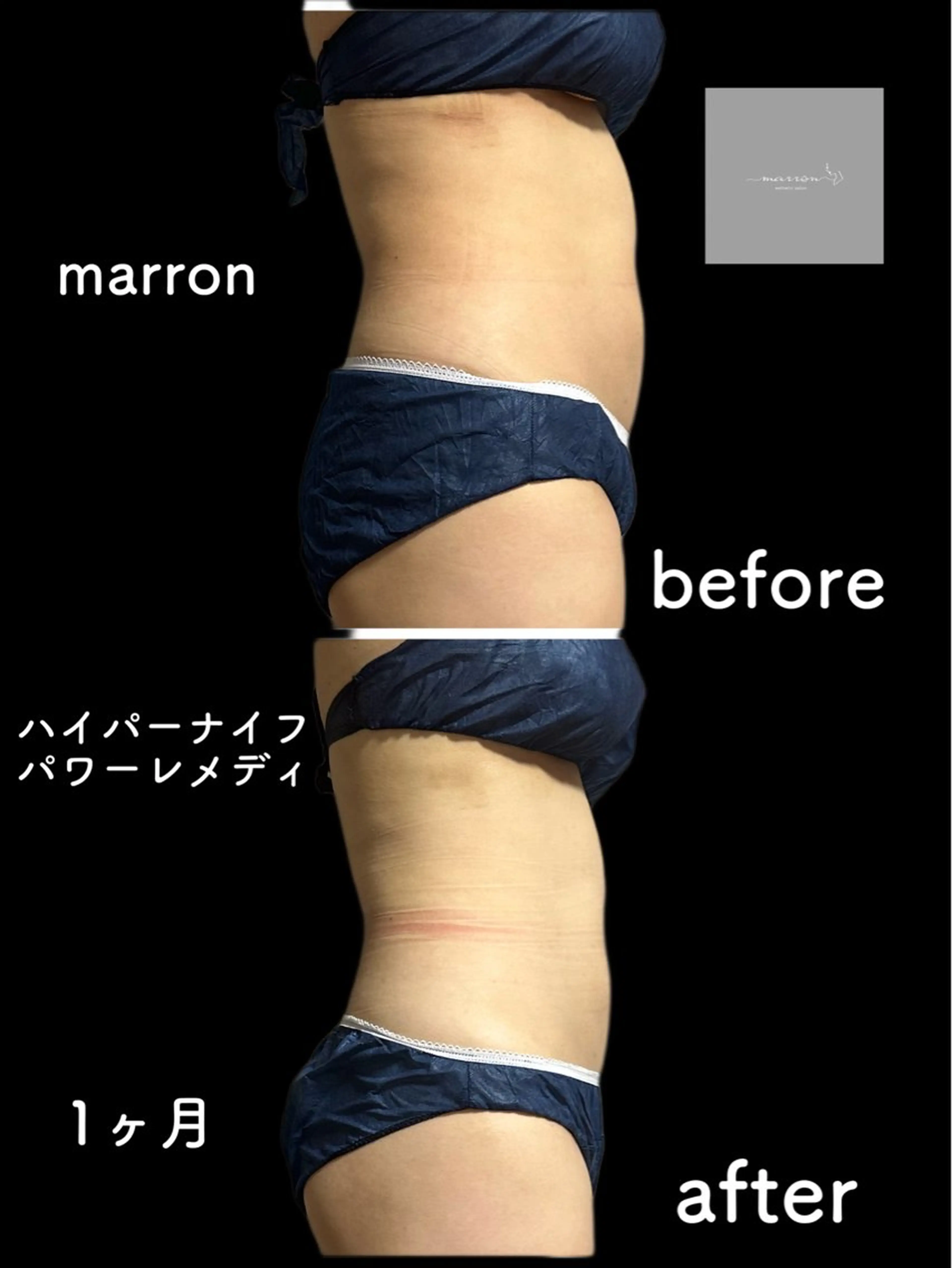 marron所属・痩身ハイパーナイフ ララピールリアボーテのエステ・リラクイメージ