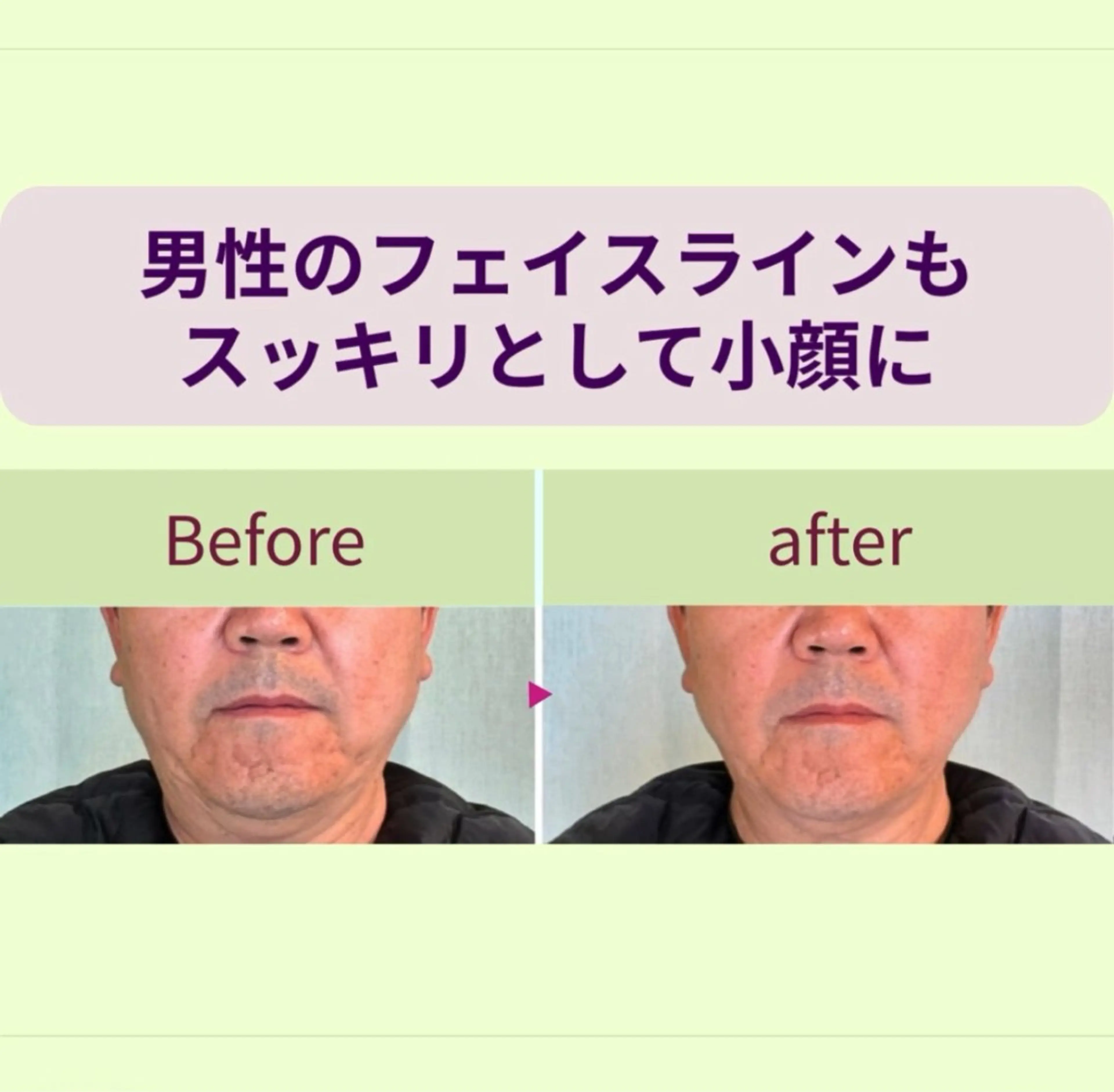 リフトアップ小顔 プランドール所属・痛くない小顔矯正 いまいあやののその他イメージ