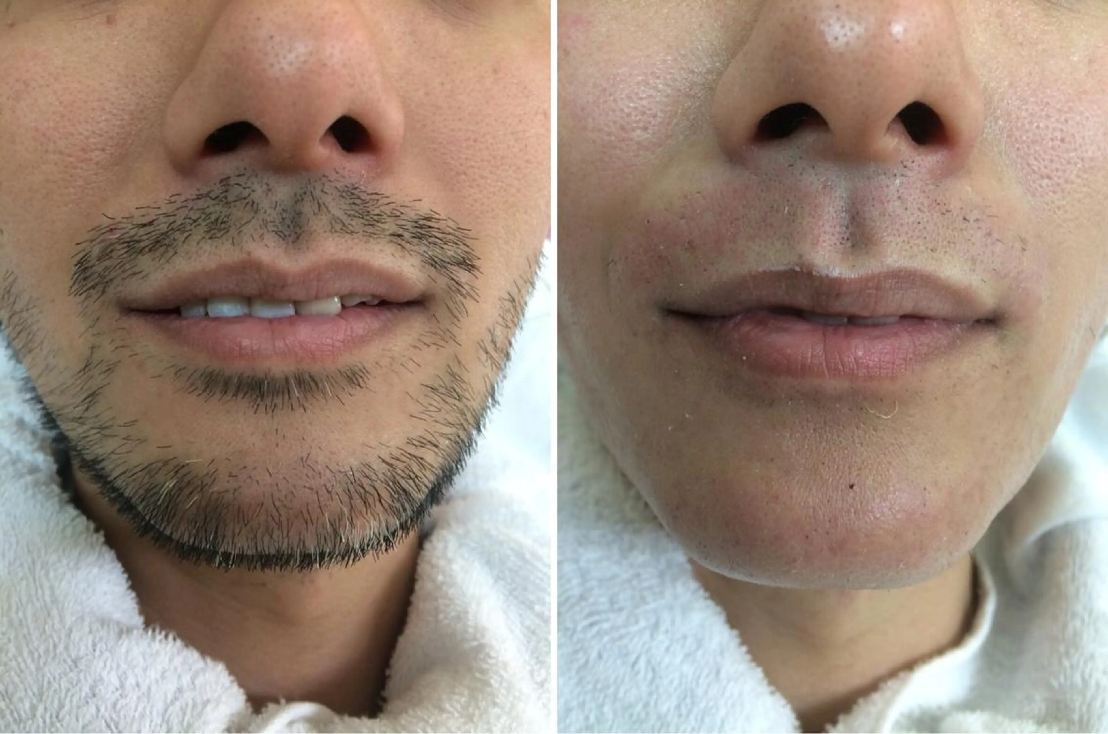 【ヒゲ脱毛】ワックス脱毛⭐️今すぐスッキリされたい方に◎　　8,800円→6,600円の写真